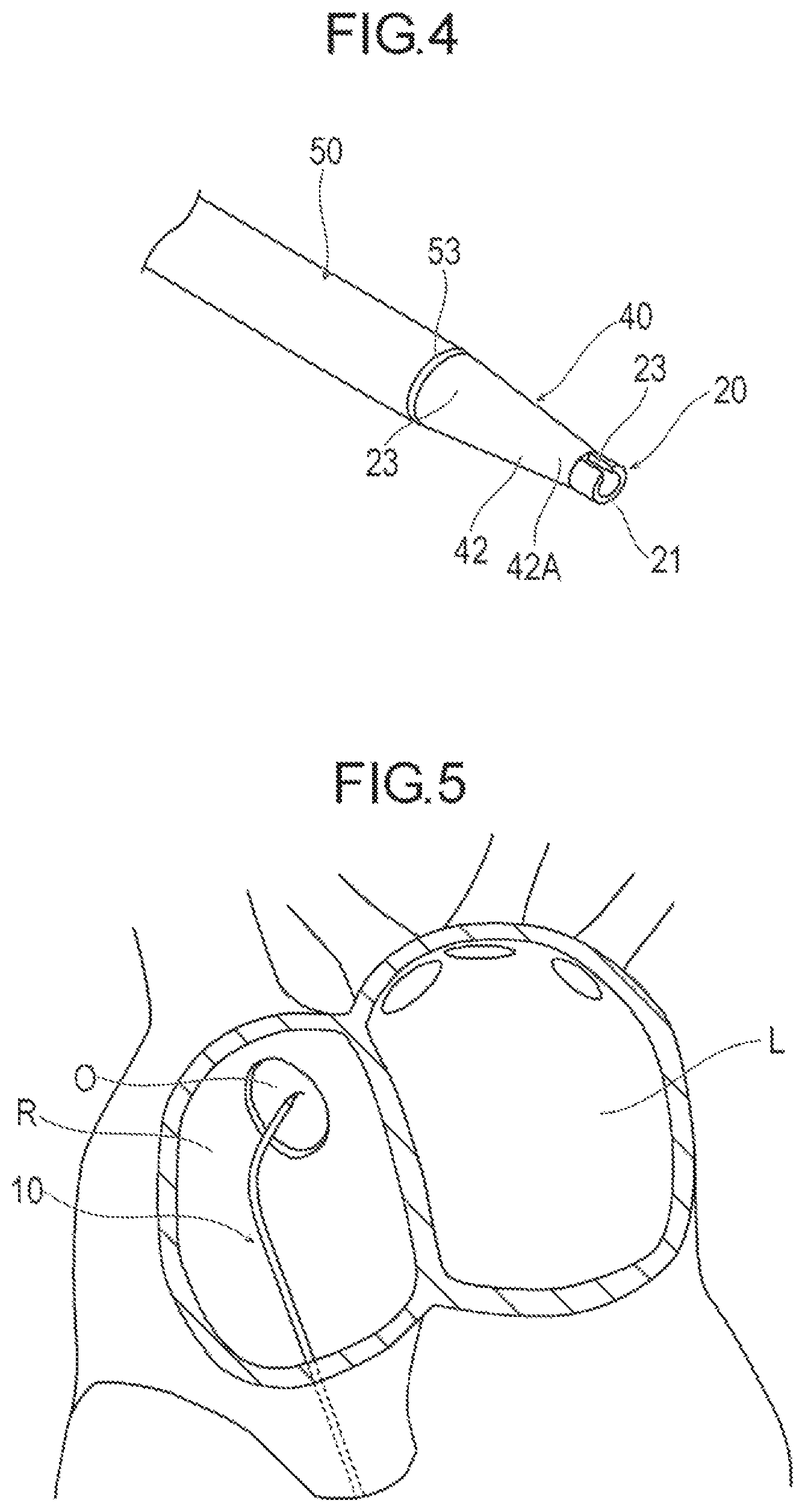 Patent US12137939 Figure 4 – Medical device and treatment method