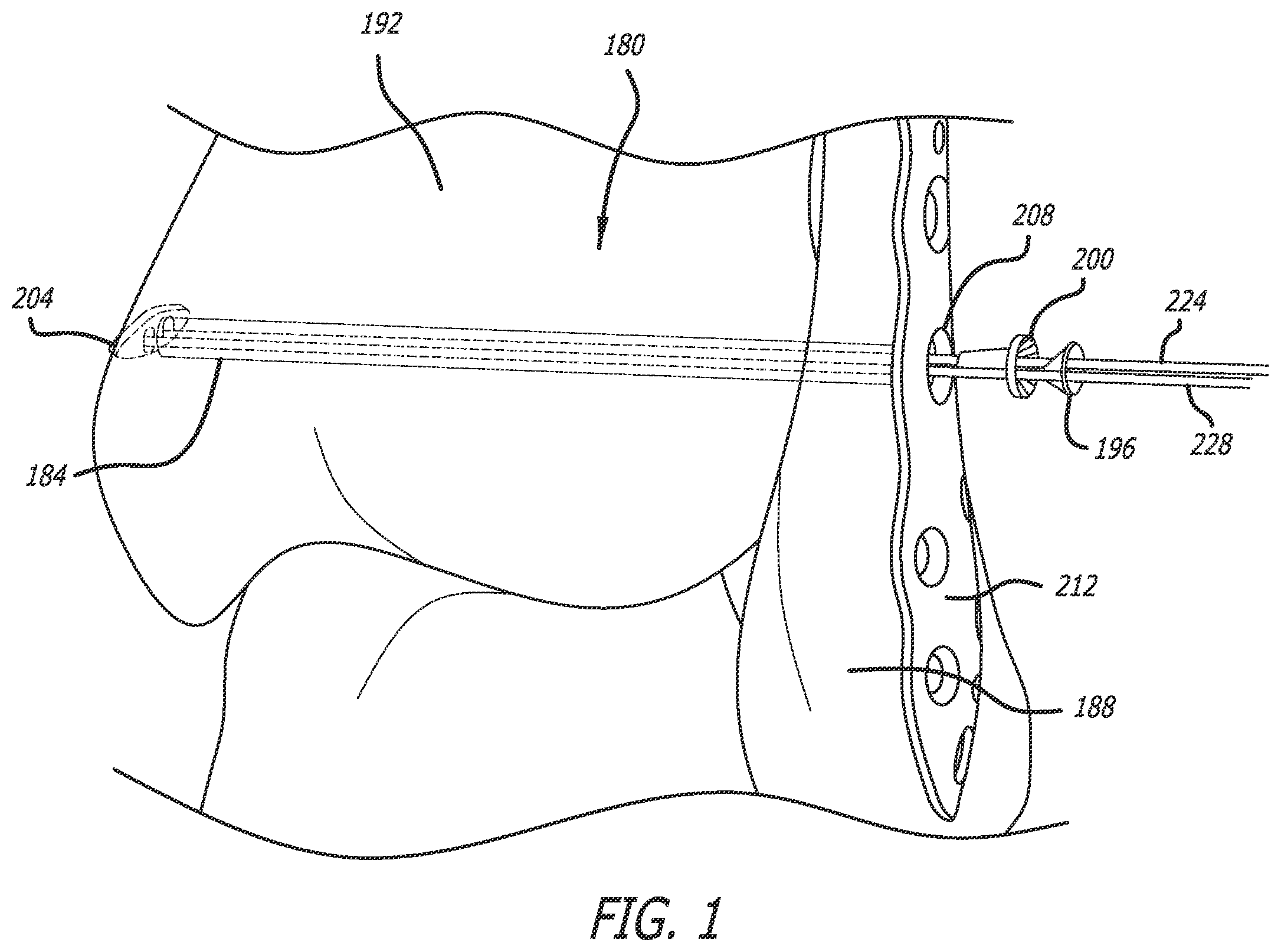 Patent US12137942 Figure 1 – Syndesmosis treatment construct