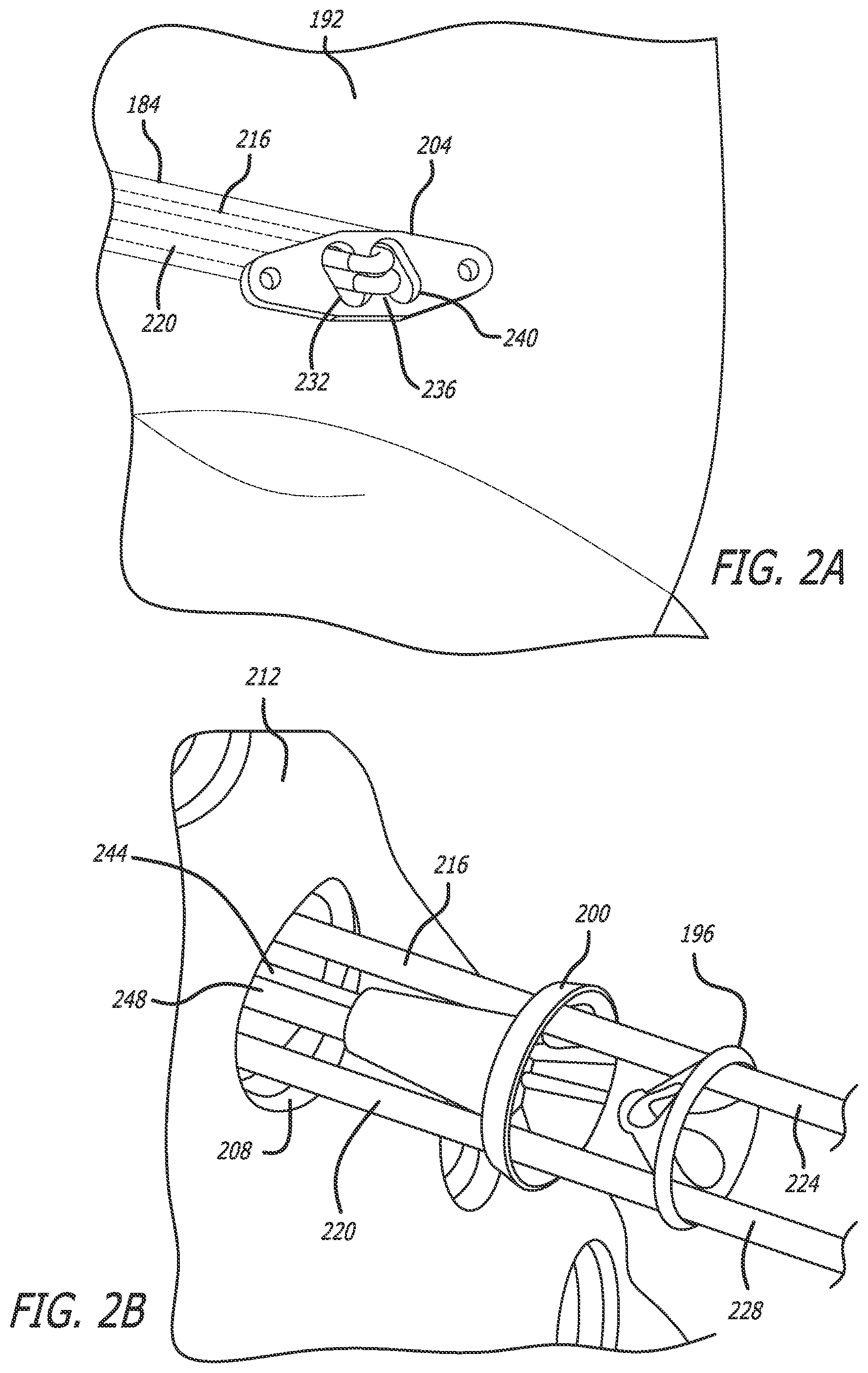 Patent US12137942 Figure 2 – Syndesmosis treatment construct