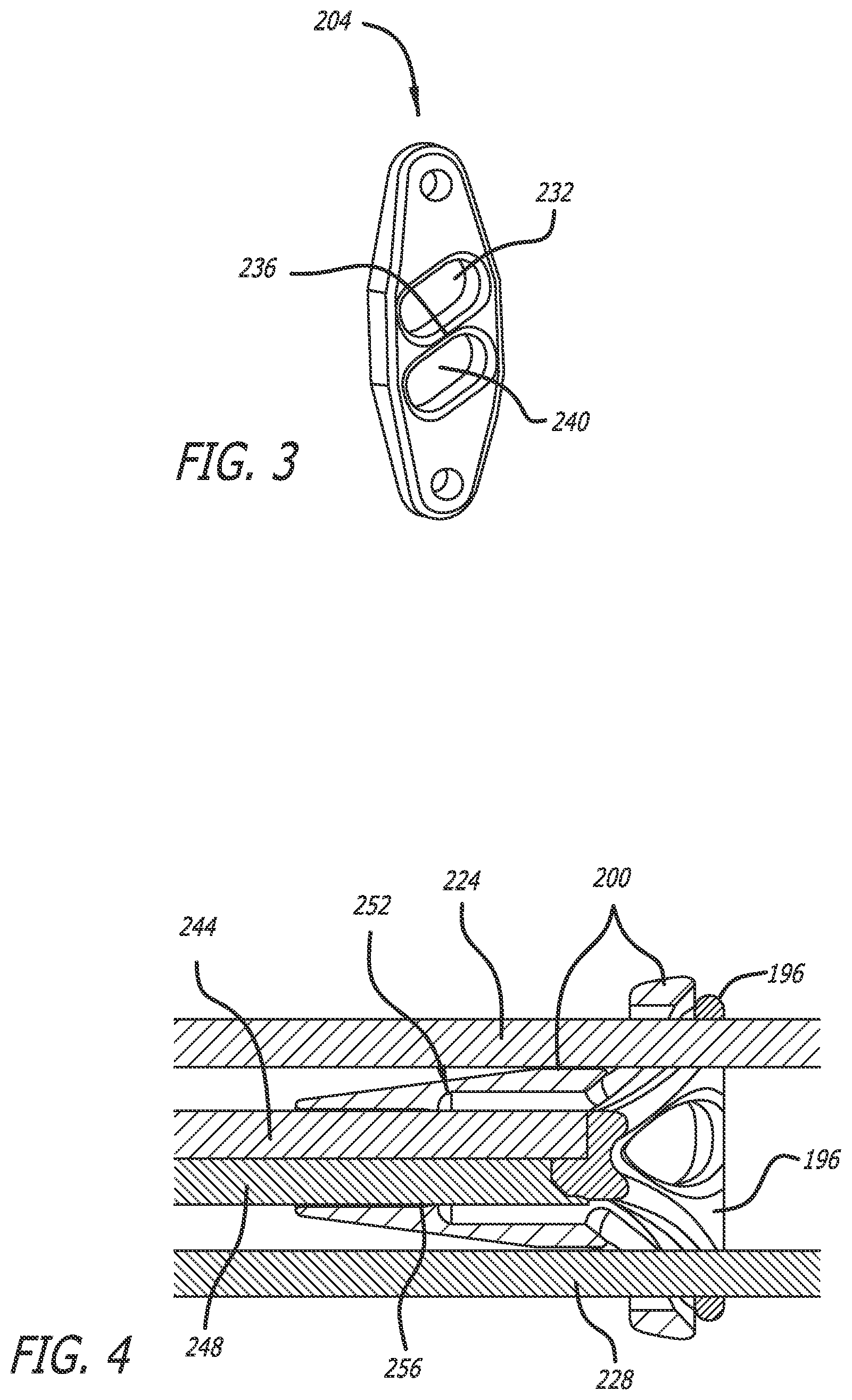 Patent US12137942 Figure 3 – Syndesmosis treatment construct