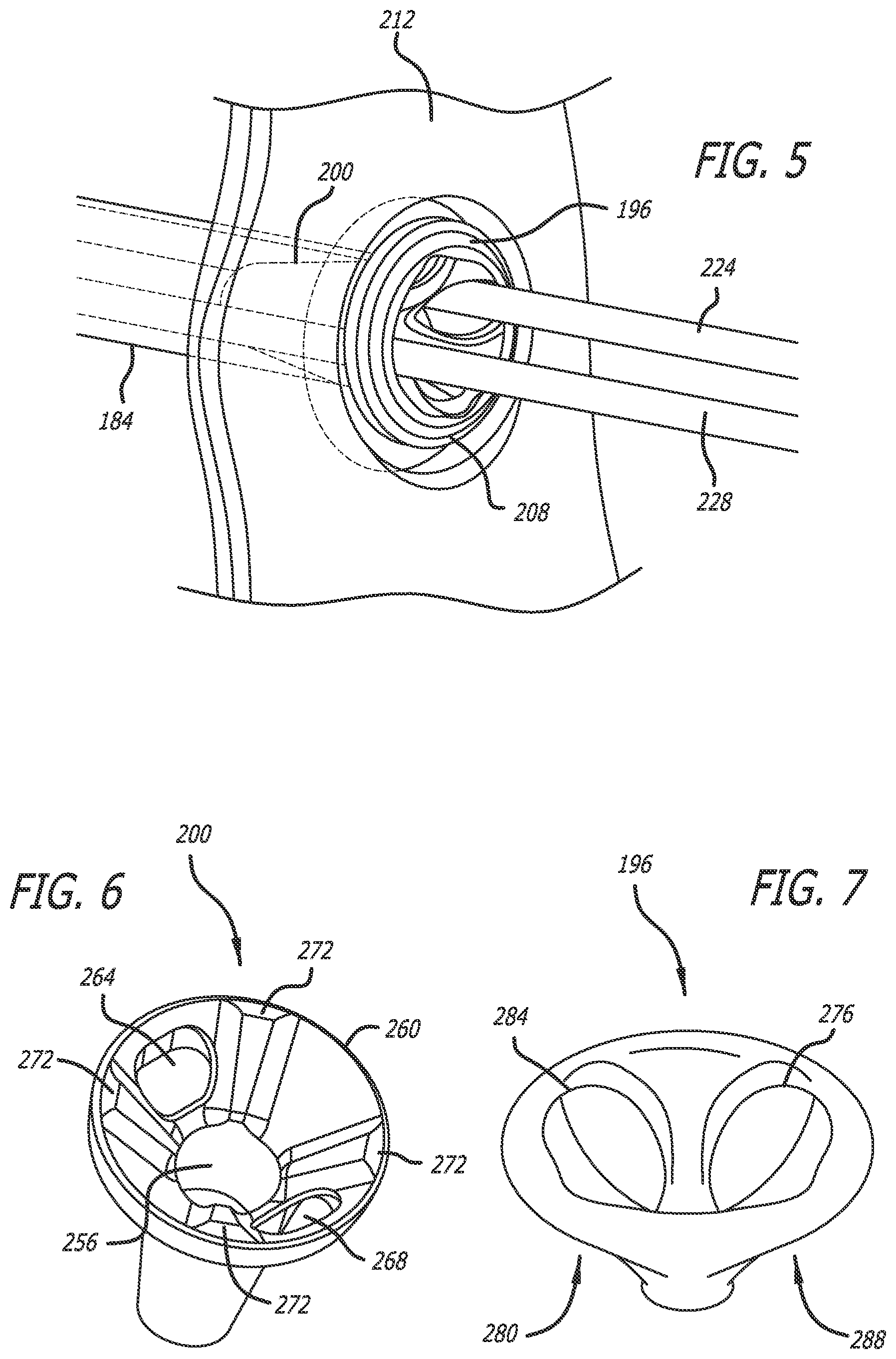 Patent US12137942 Figure 4 – Syndesmosis treatment construct