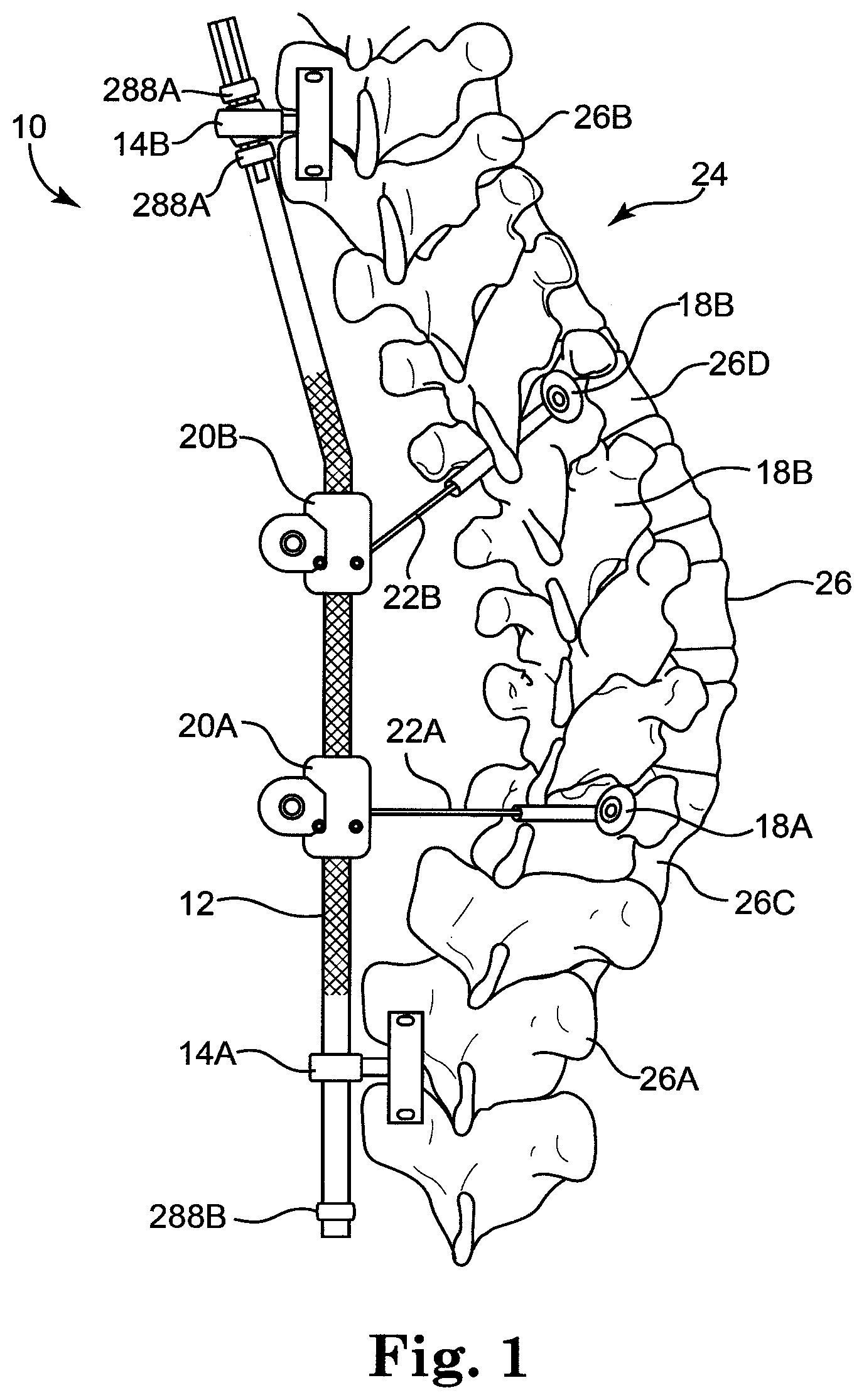 Patent US12137943 Figure 1 – Semi-constrained anchoring system