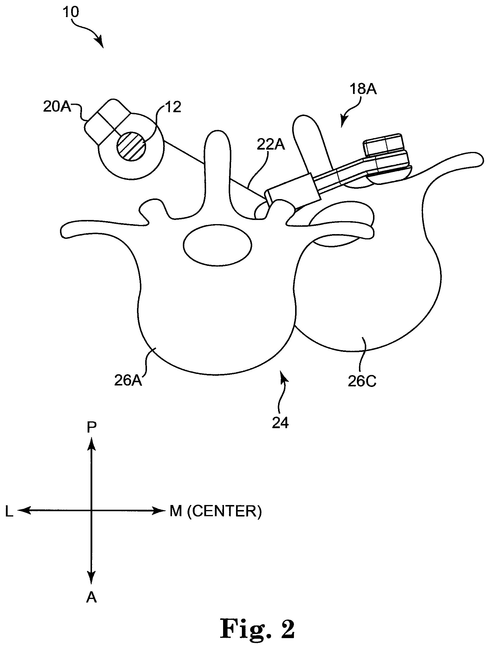 Patent US12137943 Figure 2 – Semi-constrained anchoring system