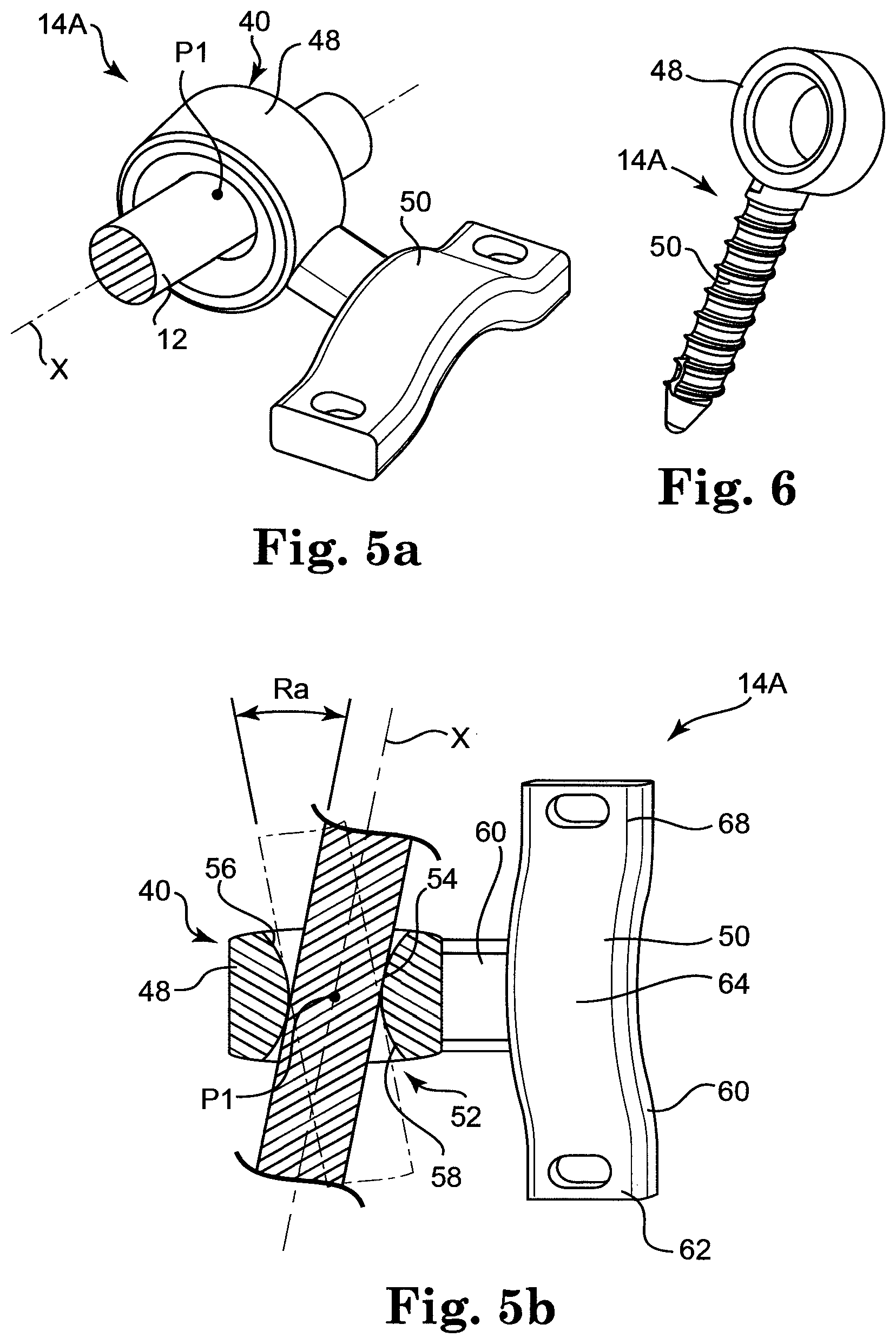 Patent US12137943 Figure 4 – Semi-constrained anchoring system
