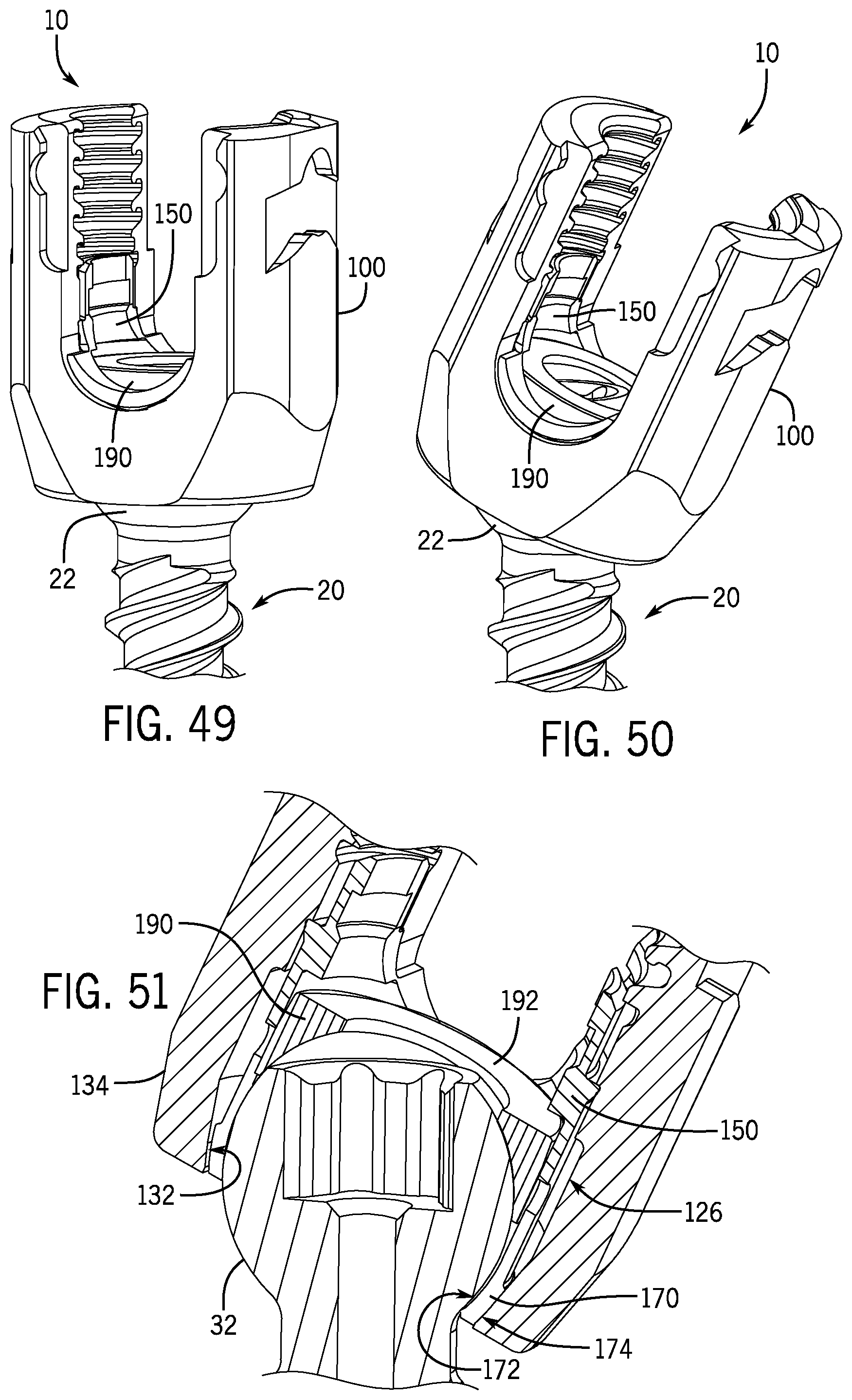 Patent US12137944 Figure 14 – Bone anchor assembly having a tool deployable insert in compressive overlapping engagement with a retainer
