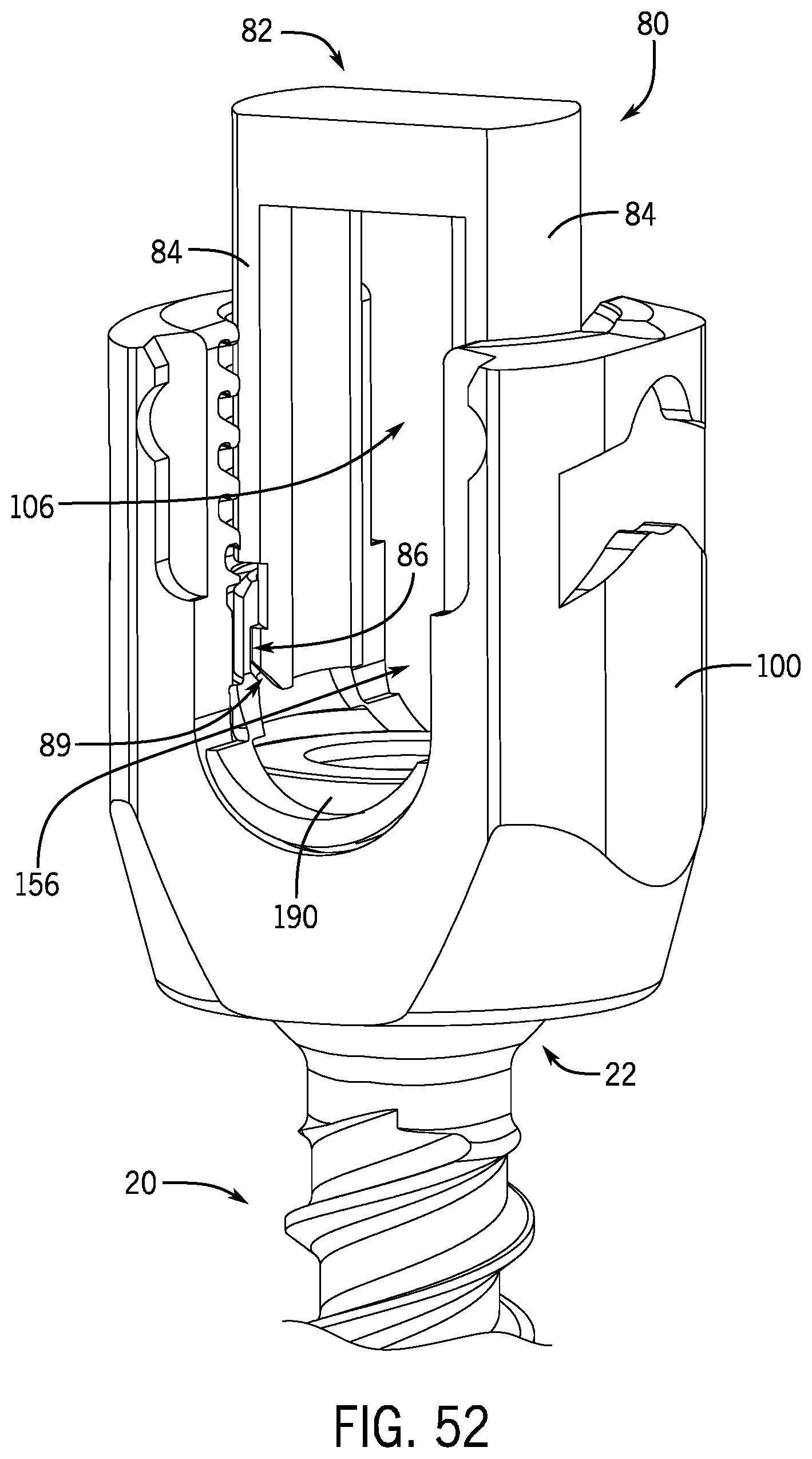 Patent US12137944 Figure 15 – Bone anchor assembly having a tool deployable insert in compressive overlapping engagement with a retainer