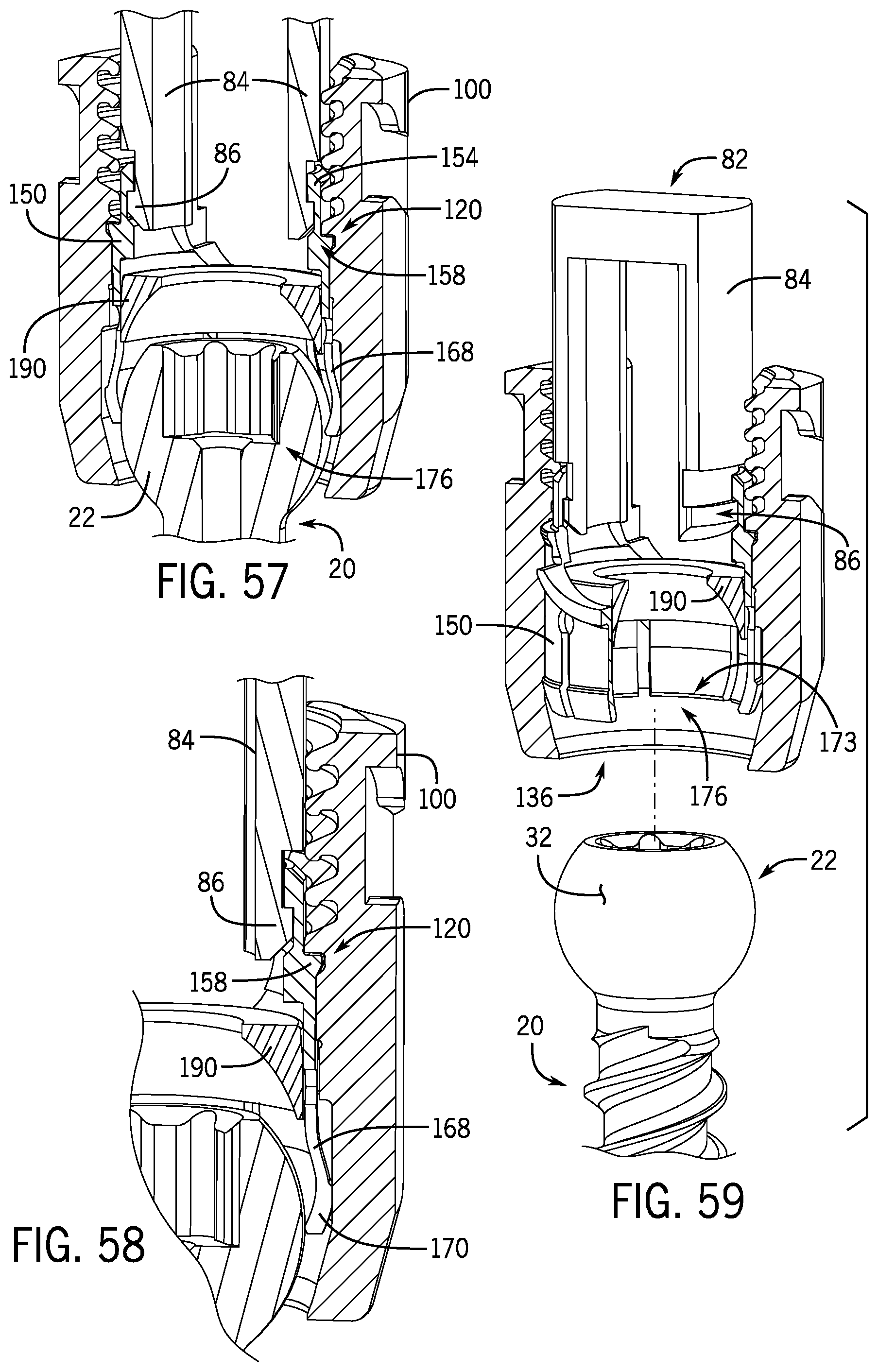 Patent US12137944 Figure 17 – Bone anchor assembly having a tool deployable insert in compressive overlapping engagement with a retainer
