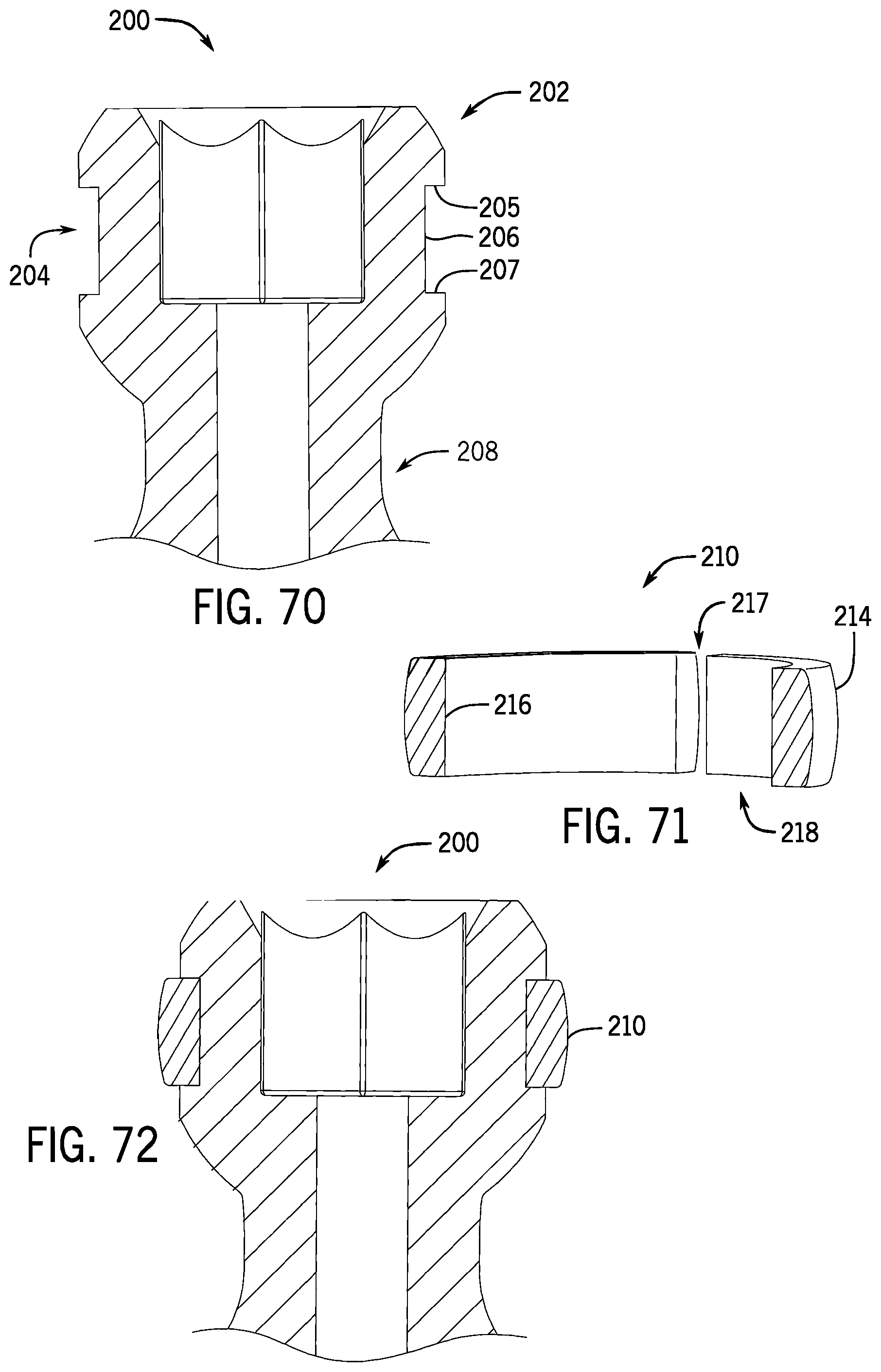 Patent US12137945 Figure 20 – Pivotal bone anchor system with modular receiver sub-assemblies and universal bone anchors
