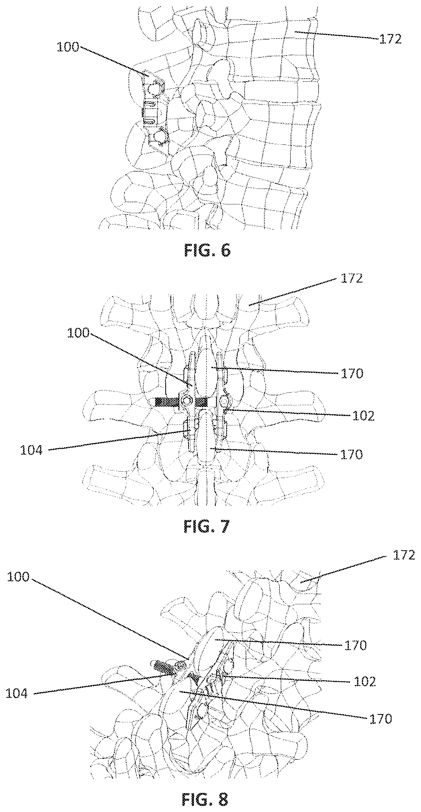 Patent US12137948 Figure 3 – Spinous process plate fixation assembly