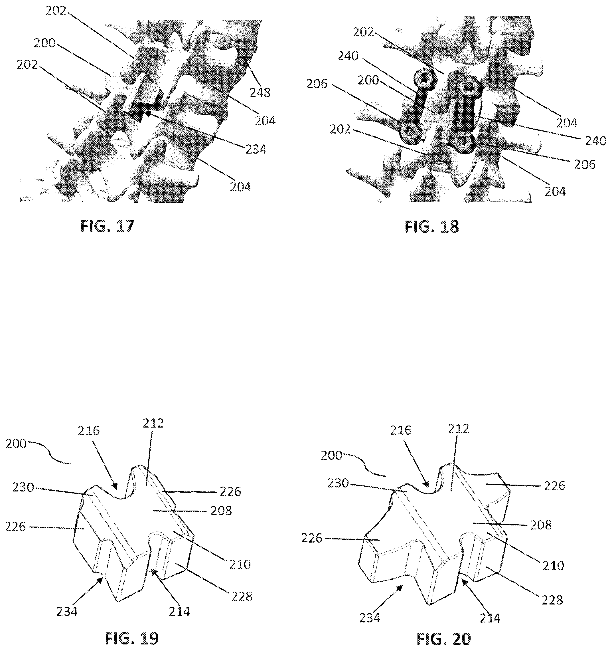 Patent US12137948 Figure 7 – Spinous process plate fixation assembly