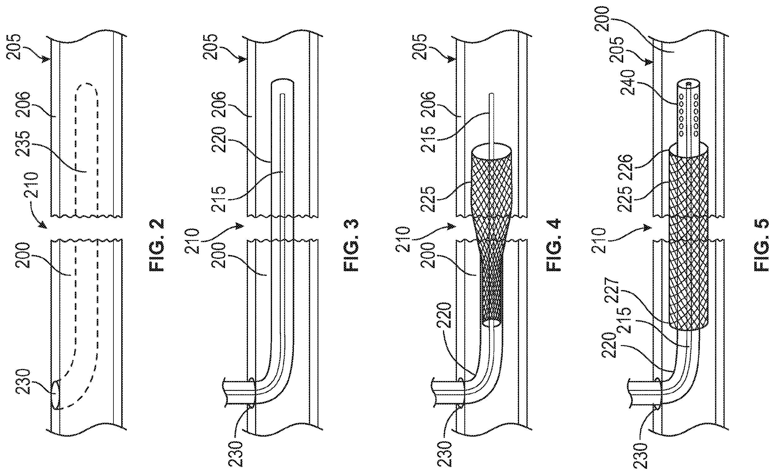 Patent US12137949 Figure 2 – Rib fracture fixation device and methods for use thereof