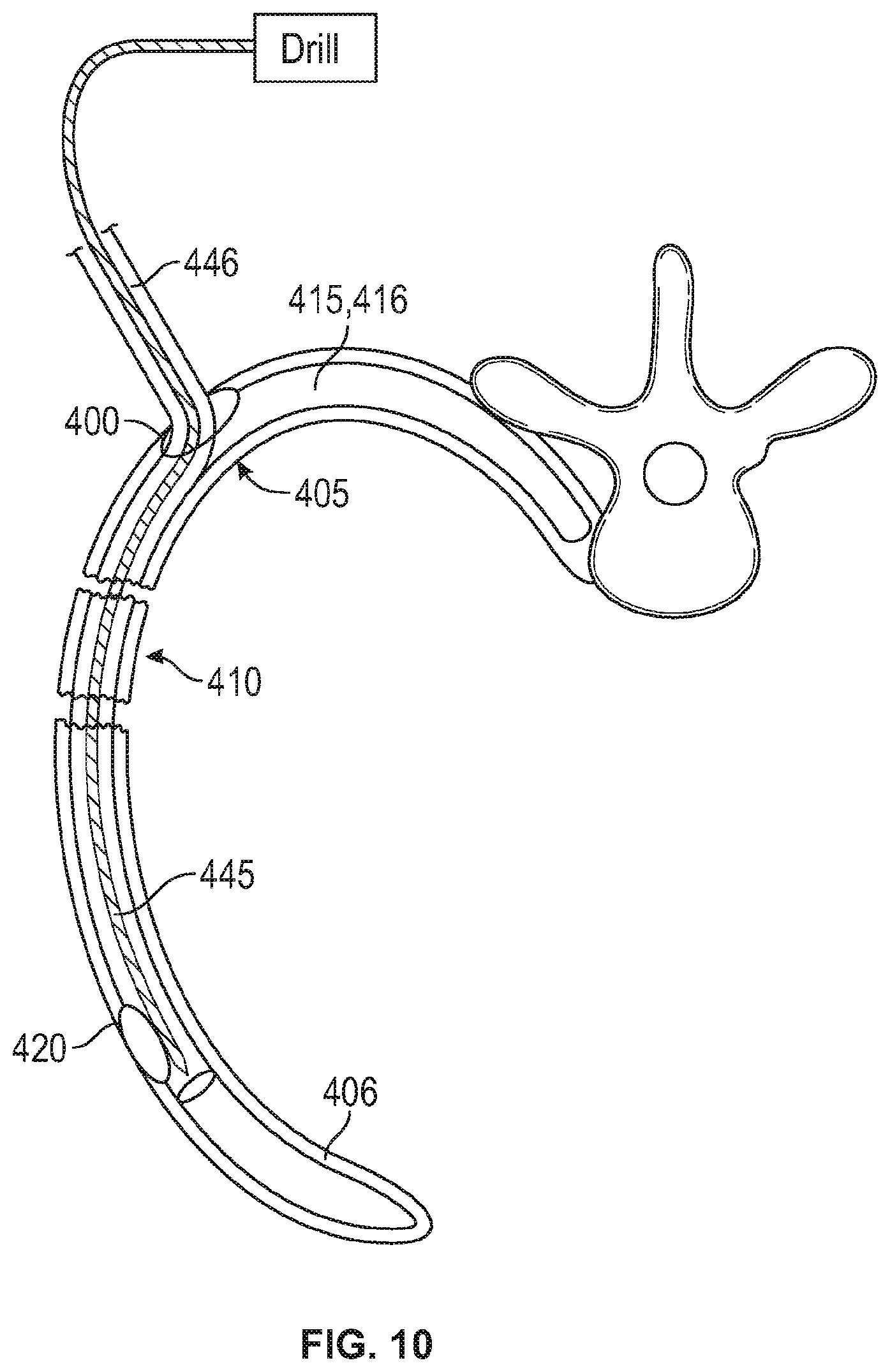 Patent US12137949 Figure 7 – Rib fracture fixation device and methods for use thereof