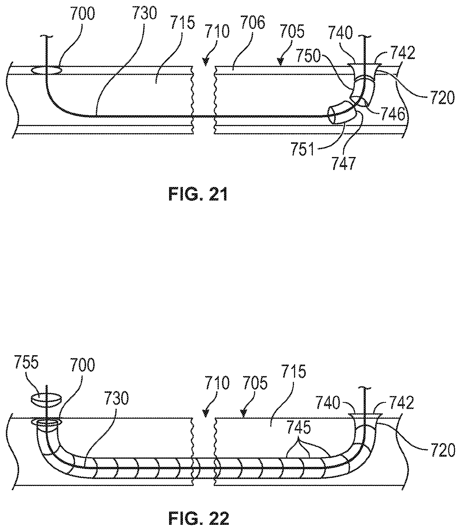 Patent US12137949 Figure 13 – Rib fracture fixation device and methods for use thereof
