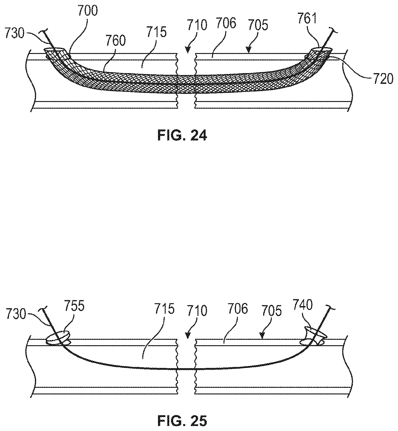 Patent US12137949 Figure 15 – Rib fracture fixation device and methods for use thereof