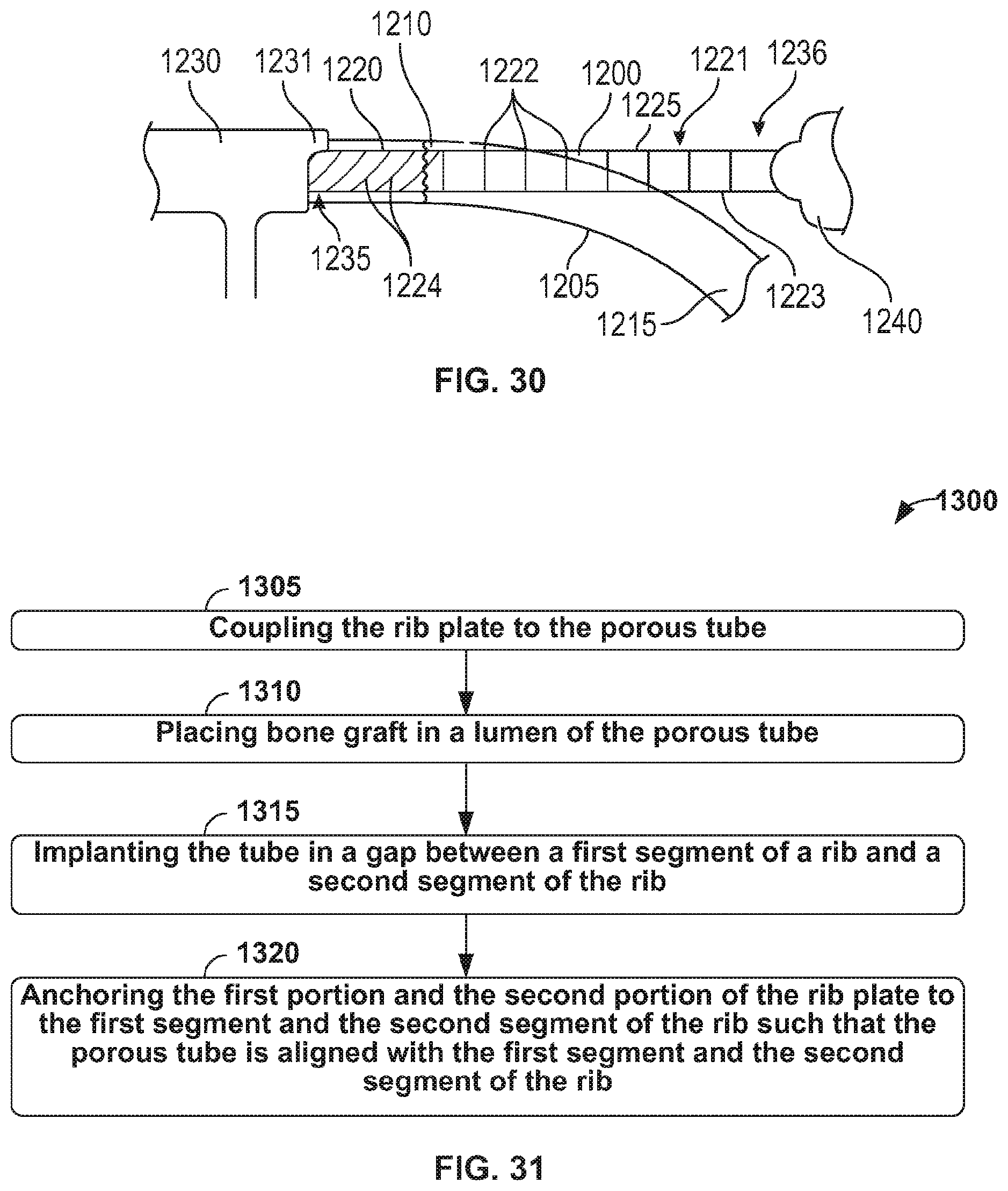 Patent US12137949 Figure 18 – Rib fracture fixation device and methods for use thereof