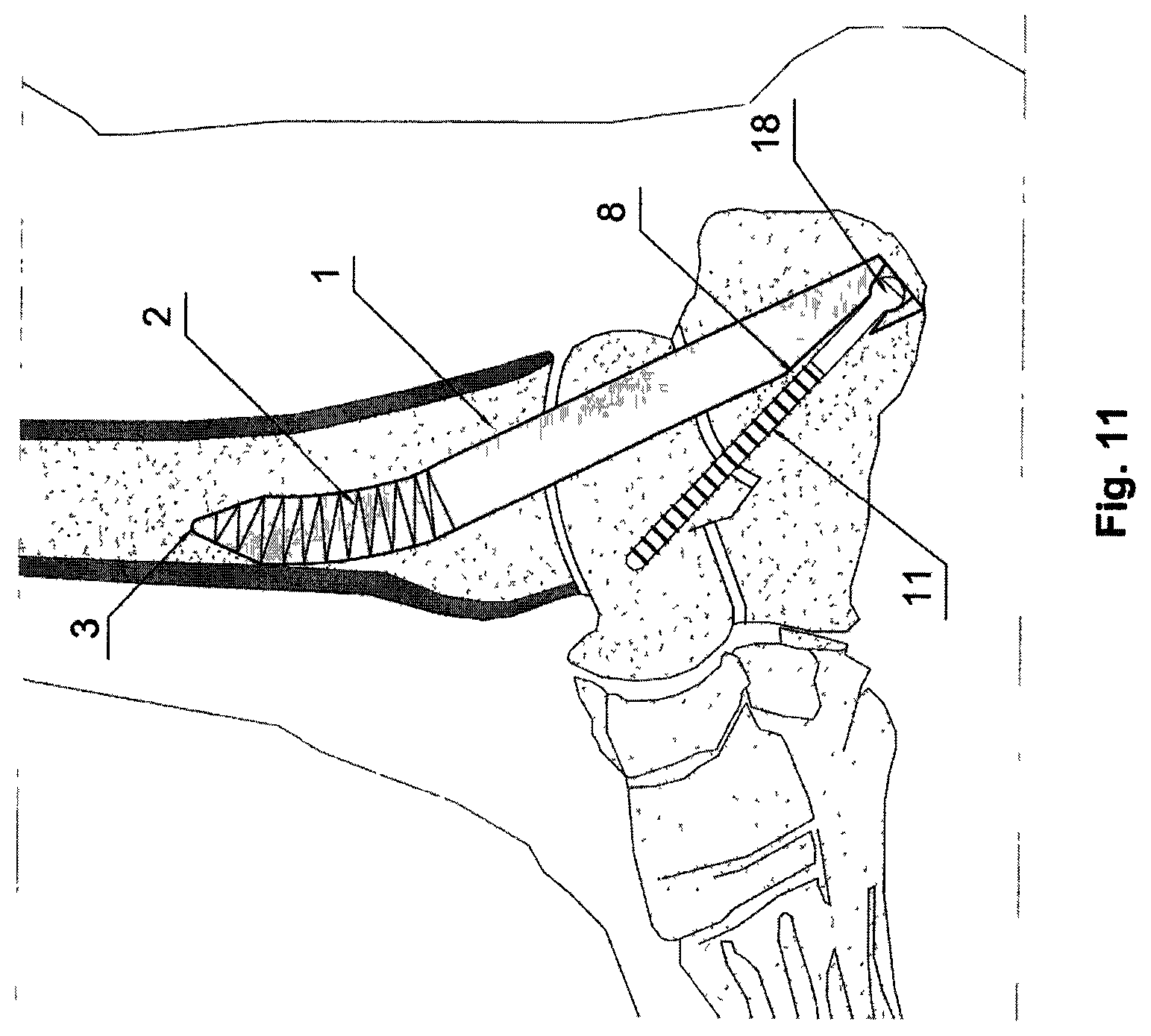 Patent US12137950 Figure 6 – Bone nail