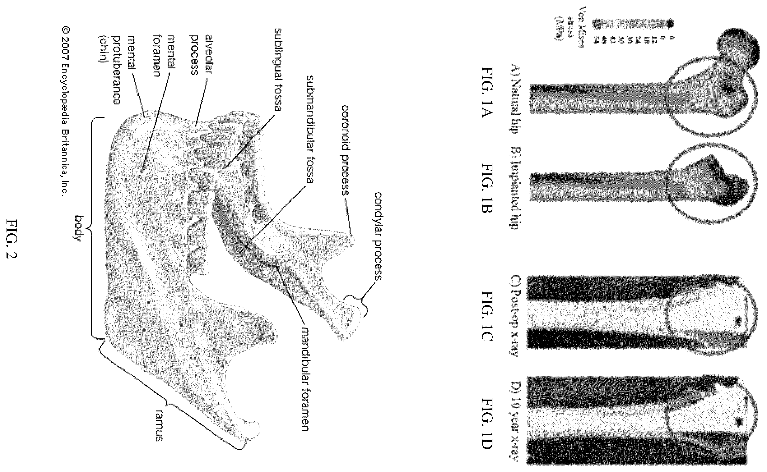 Patent US12137952 Figure 1 – Methods, devices, and manufacture of the devices for musculoskeletal reconstructive surgery