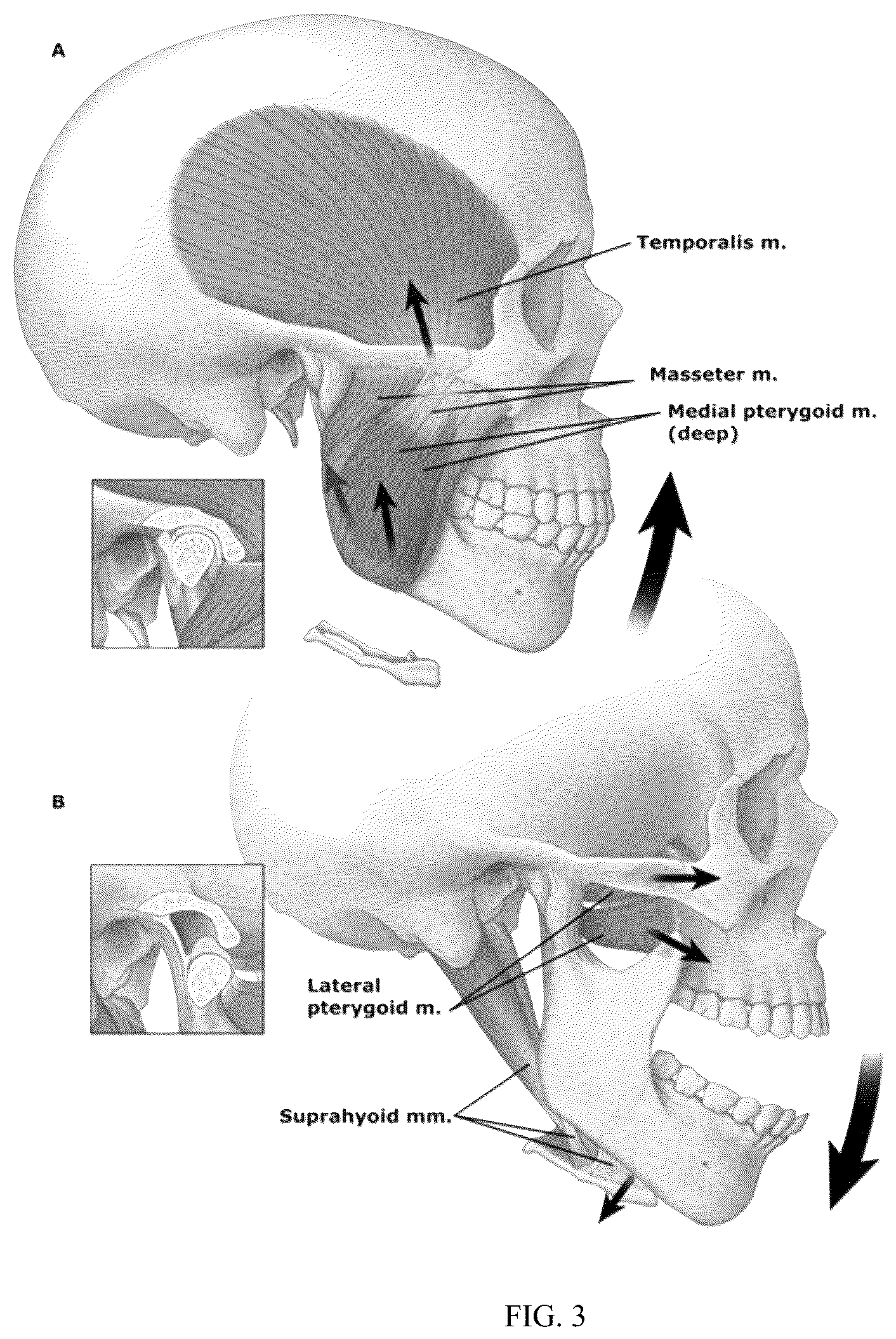 Patent US12137952 Figure 2 – Methods, devices, and manufacture of the devices for musculoskeletal reconstructive surgery
