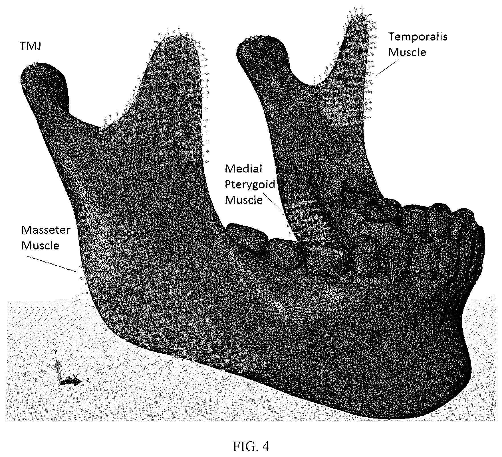 Patent US12137952 Figure 3 – Methods, devices, and manufacture of the devices for musculoskeletal reconstructive surgery