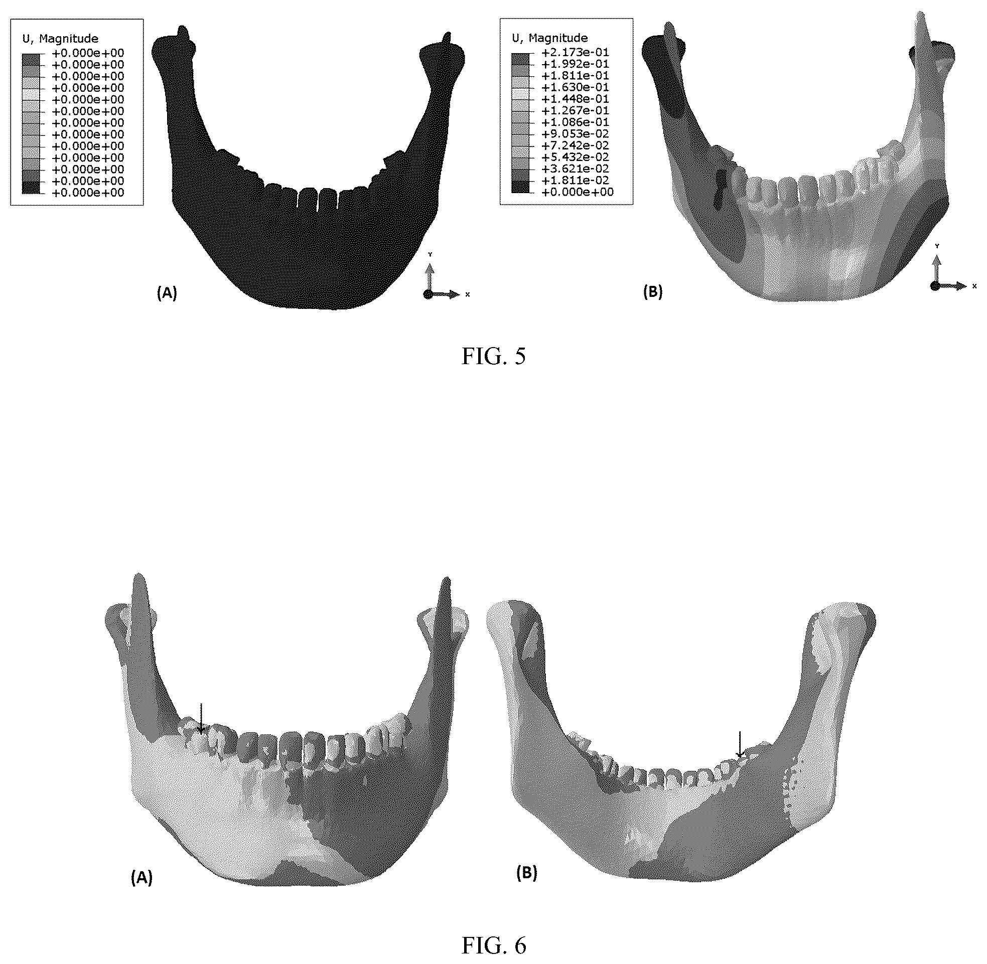 Patent US12137952 Figure 4 – Methods, devices, and manufacture of the devices for musculoskeletal reconstructive surgery