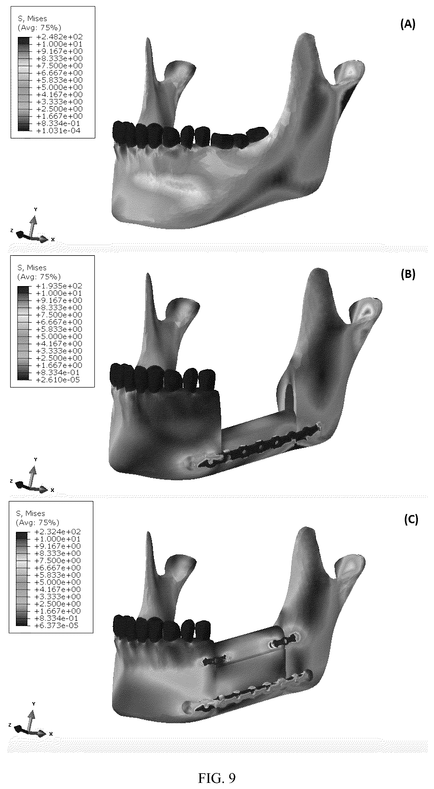 Patent US12137952 Figure 6 – Methods, devices, and manufacture of the devices for musculoskeletal reconstructive surgery