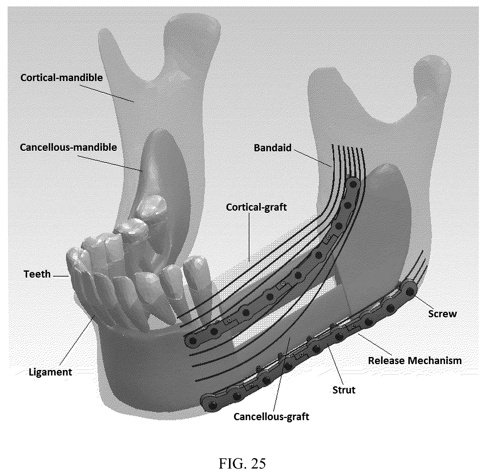 Patent US12137952 Figure 18 – Methods, devices, and manufacture of the devices for musculoskeletal reconstructive surgery