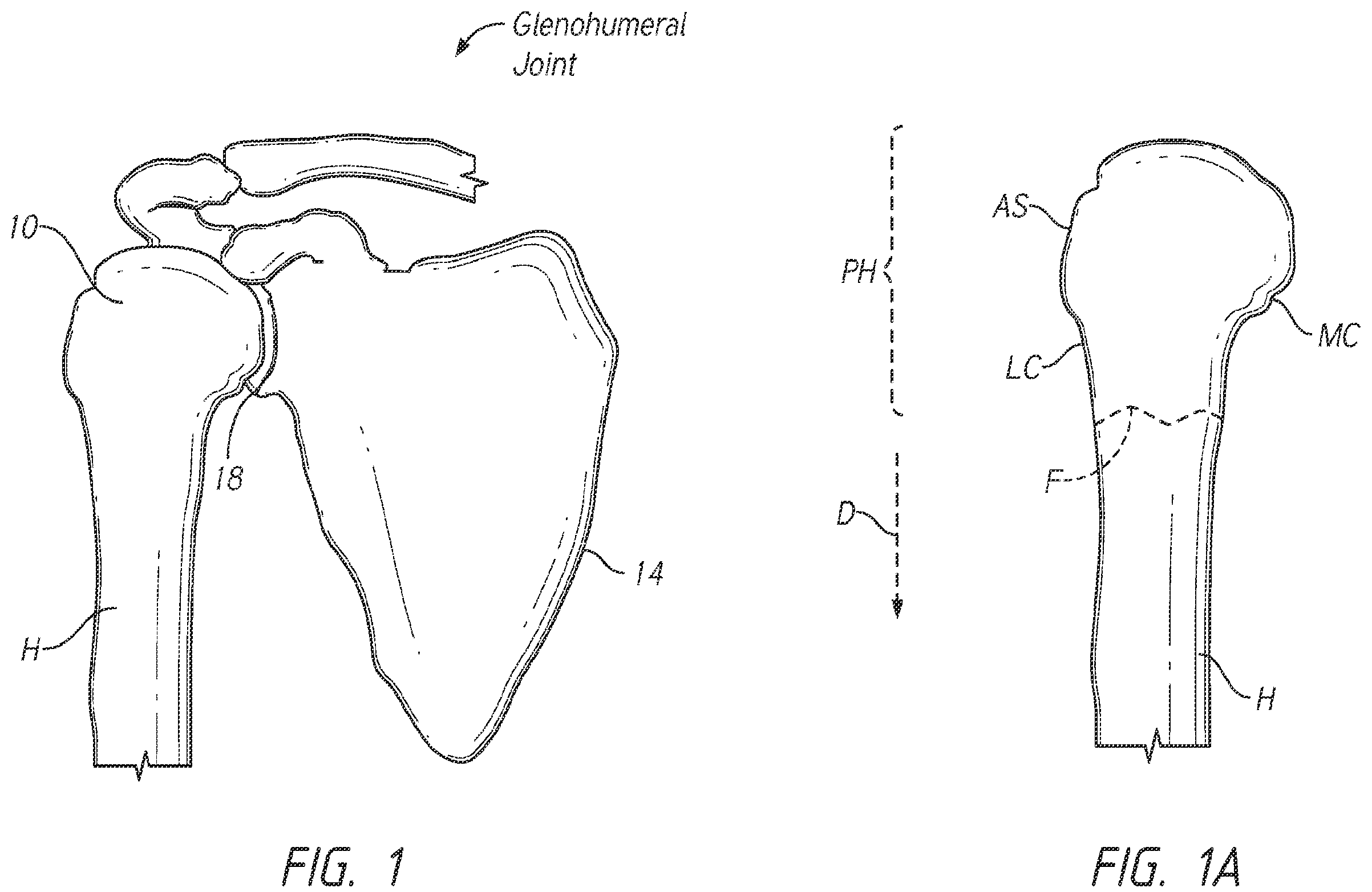 Patent US12137953 Figure 1 – Humeral fixation plates