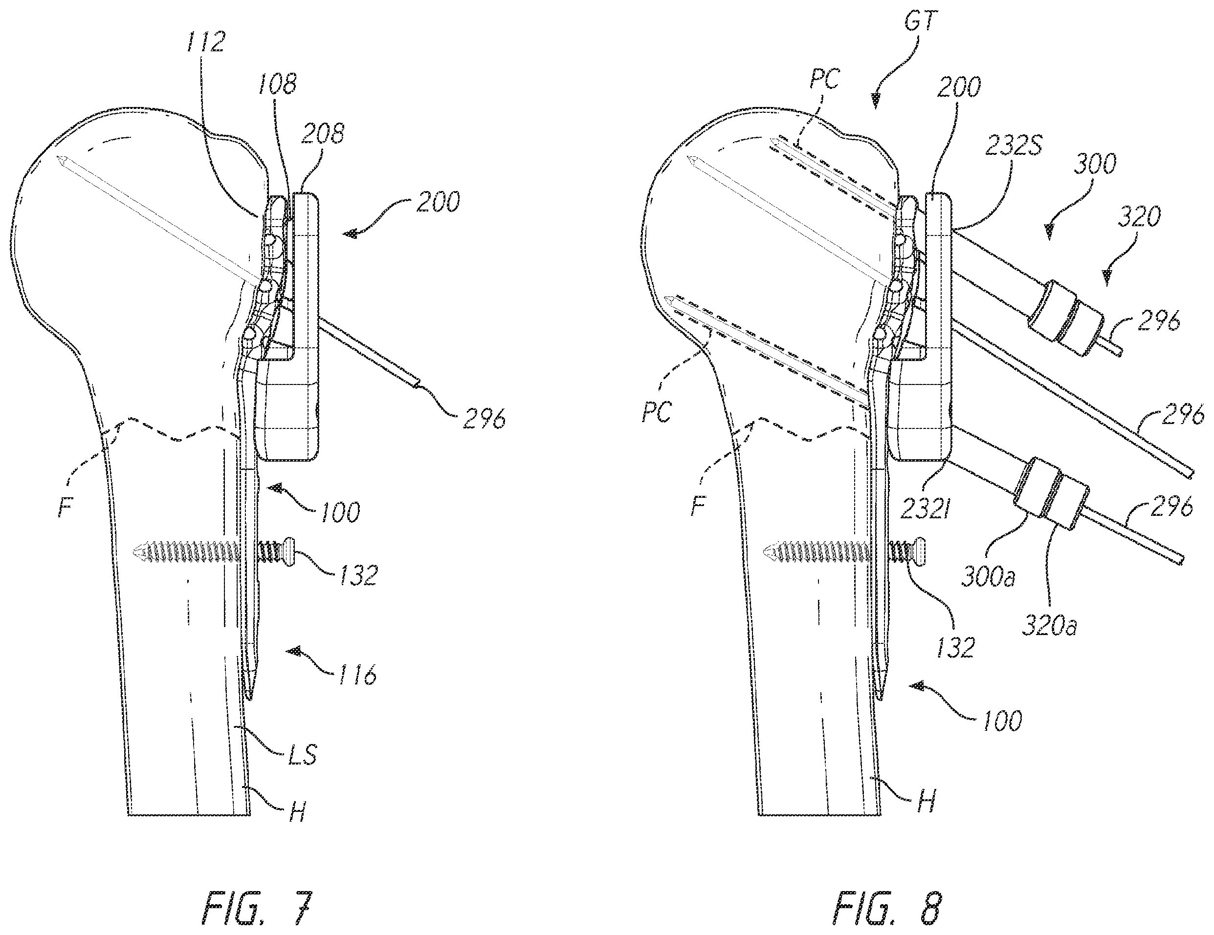 Patent US12137953 Figure 9 – Humeral fixation plates