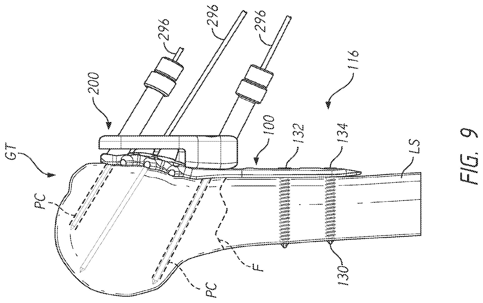 Patent US12137953 Figure 14 – Humeral fixation plates