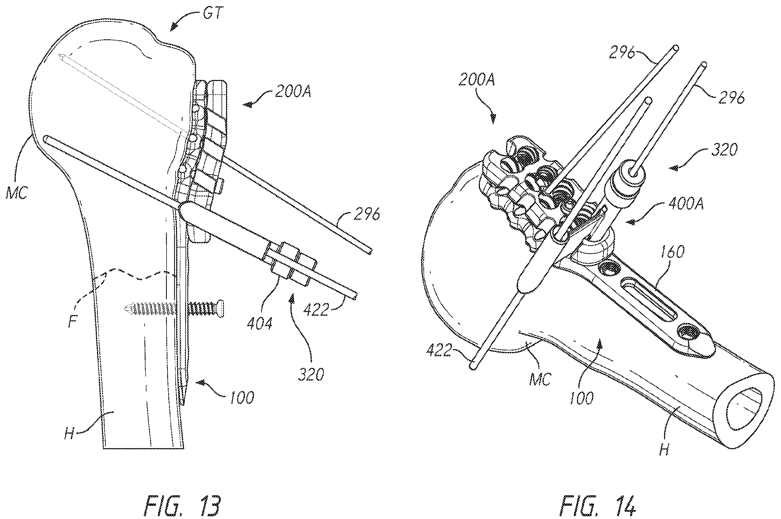 Patent US12137953 Figure 17 – Humeral fixation plates