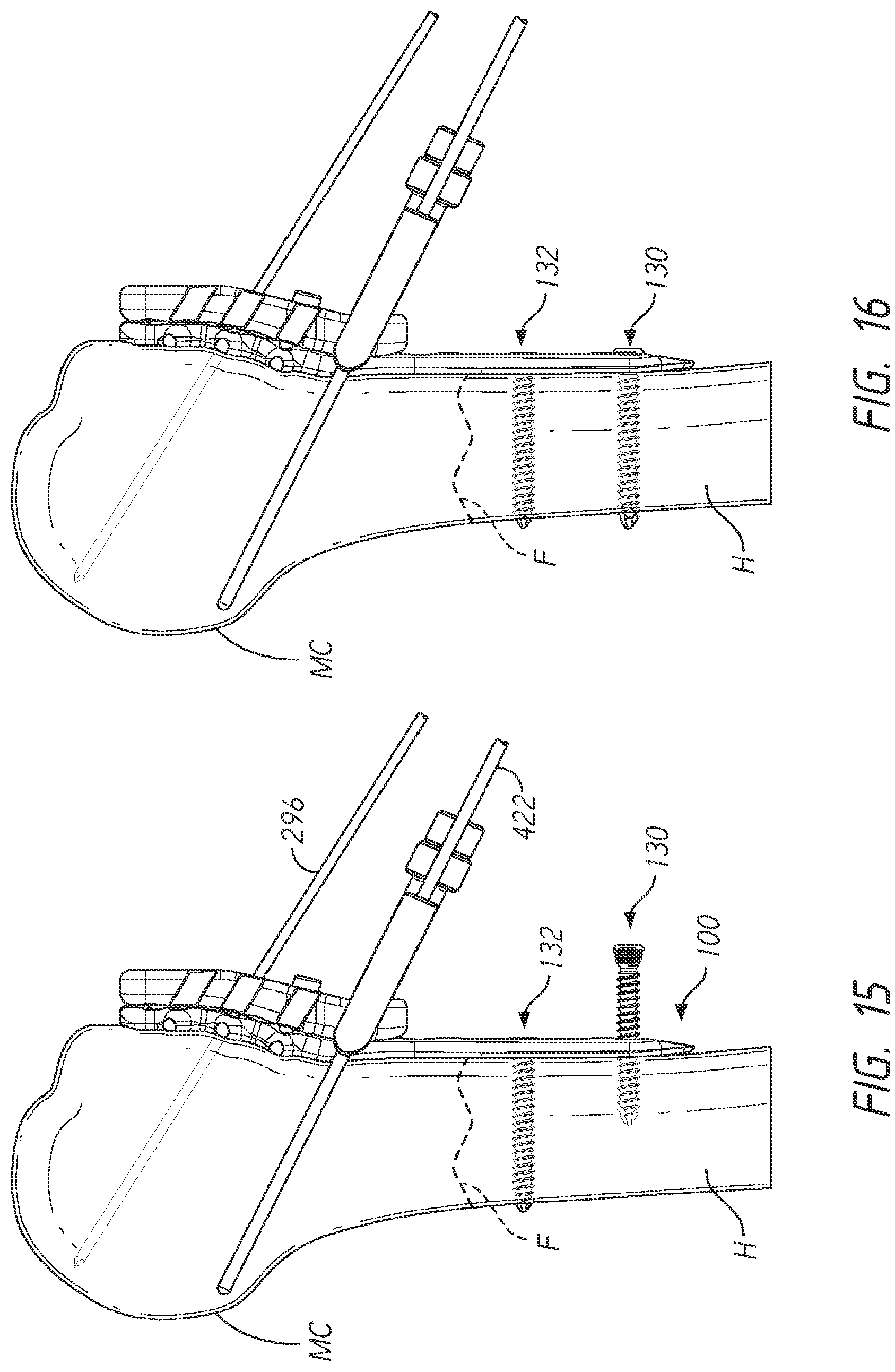 Patent US12137953 Figure 18 – Humeral fixation plates