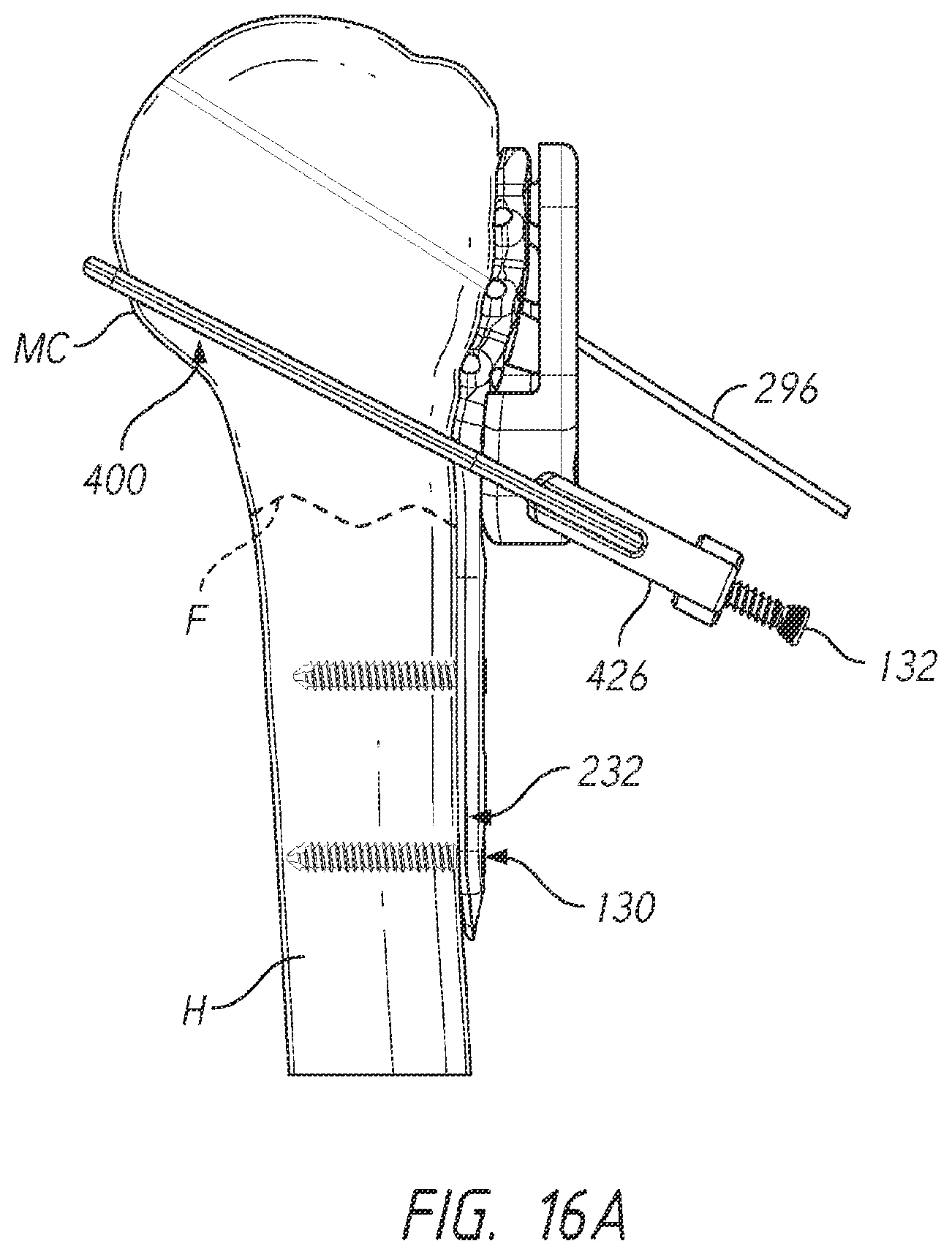 Patent US12137953 Figure 19 – Humeral fixation plates