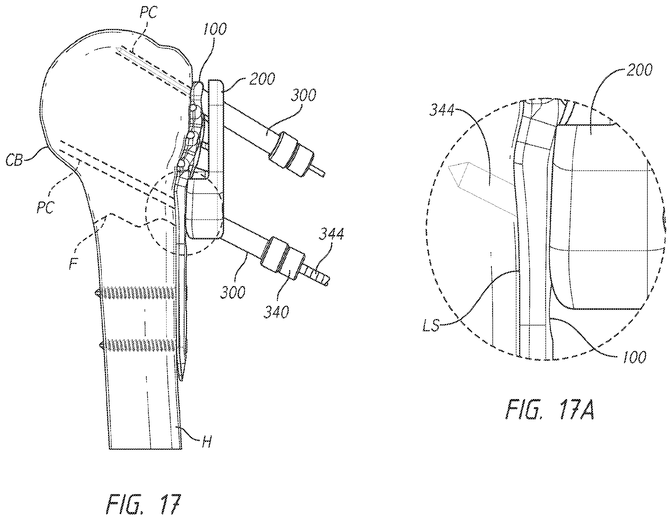 Patent US12137953 Figure 20 – Humeral fixation plates