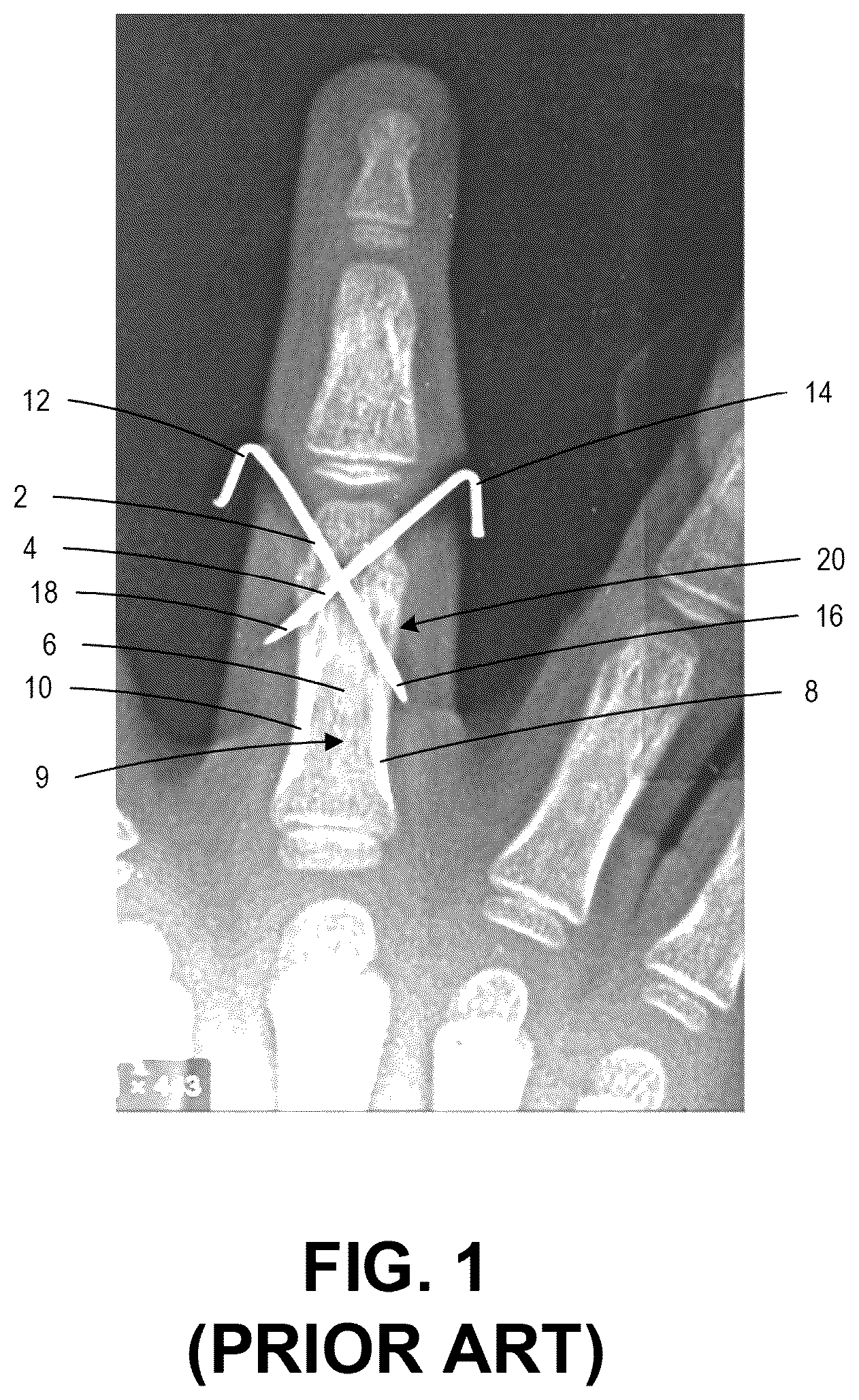 Patent US12137956 Figure 1 – Orthopedic implants and instruments for delivering the same
