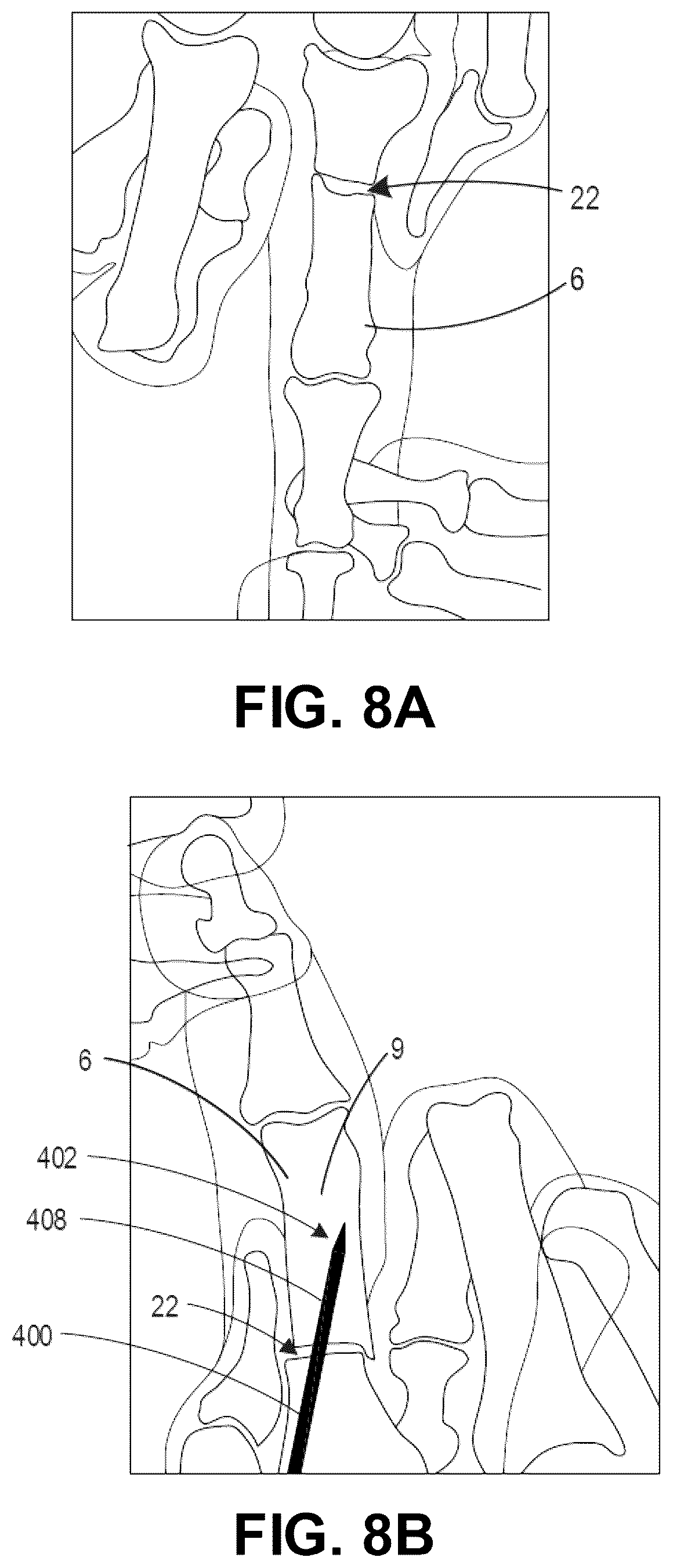 Patent US12137956 Figure 10 – Orthopedic implants and instruments for delivering the same