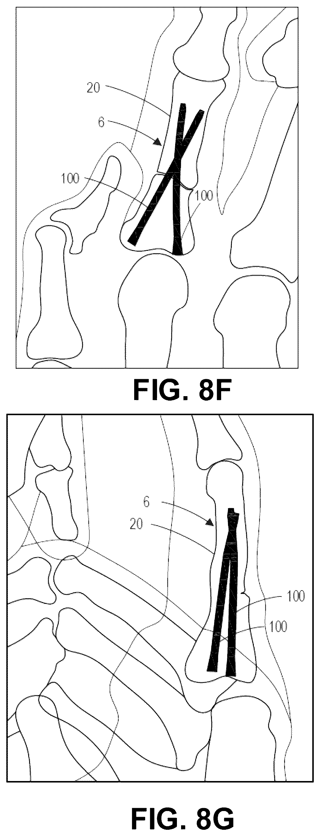 Patent US12137956 Figure 14 – Orthopedic implants and instruments for delivering the same
