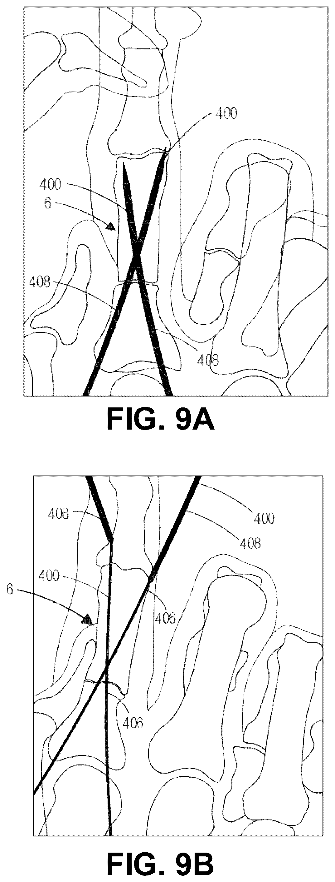 Patent US12137956 Figure 15 – Orthopedic implants and instruments for delivering the same