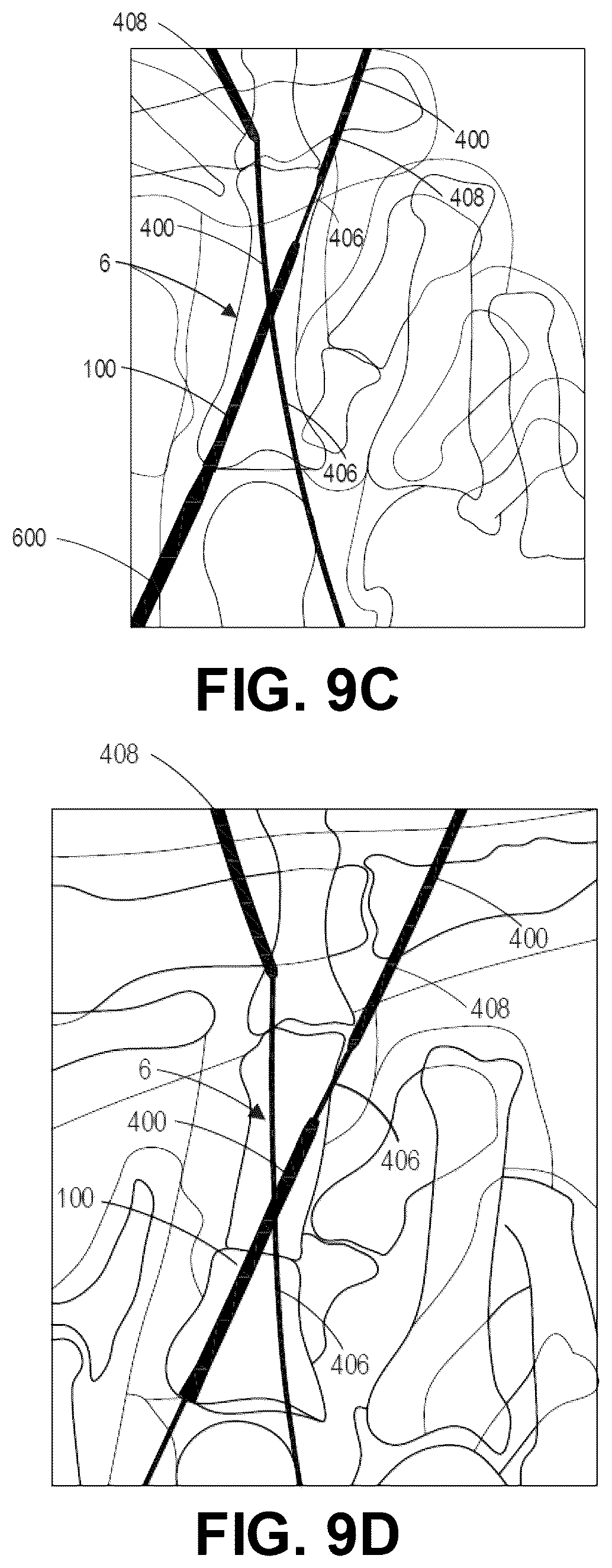 Patent US12137956 Figure 16 – Orthopedic implants and instruments for delivering the same