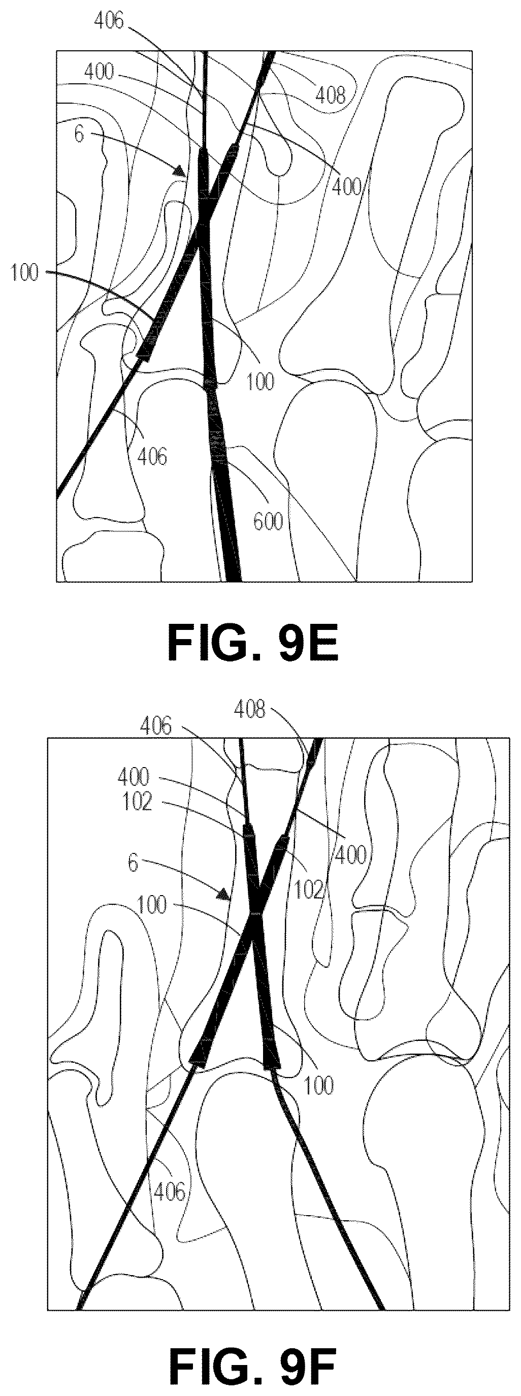 Patent US12137956 Figure 17 – Orthopedic implants and instruments for delivering the same