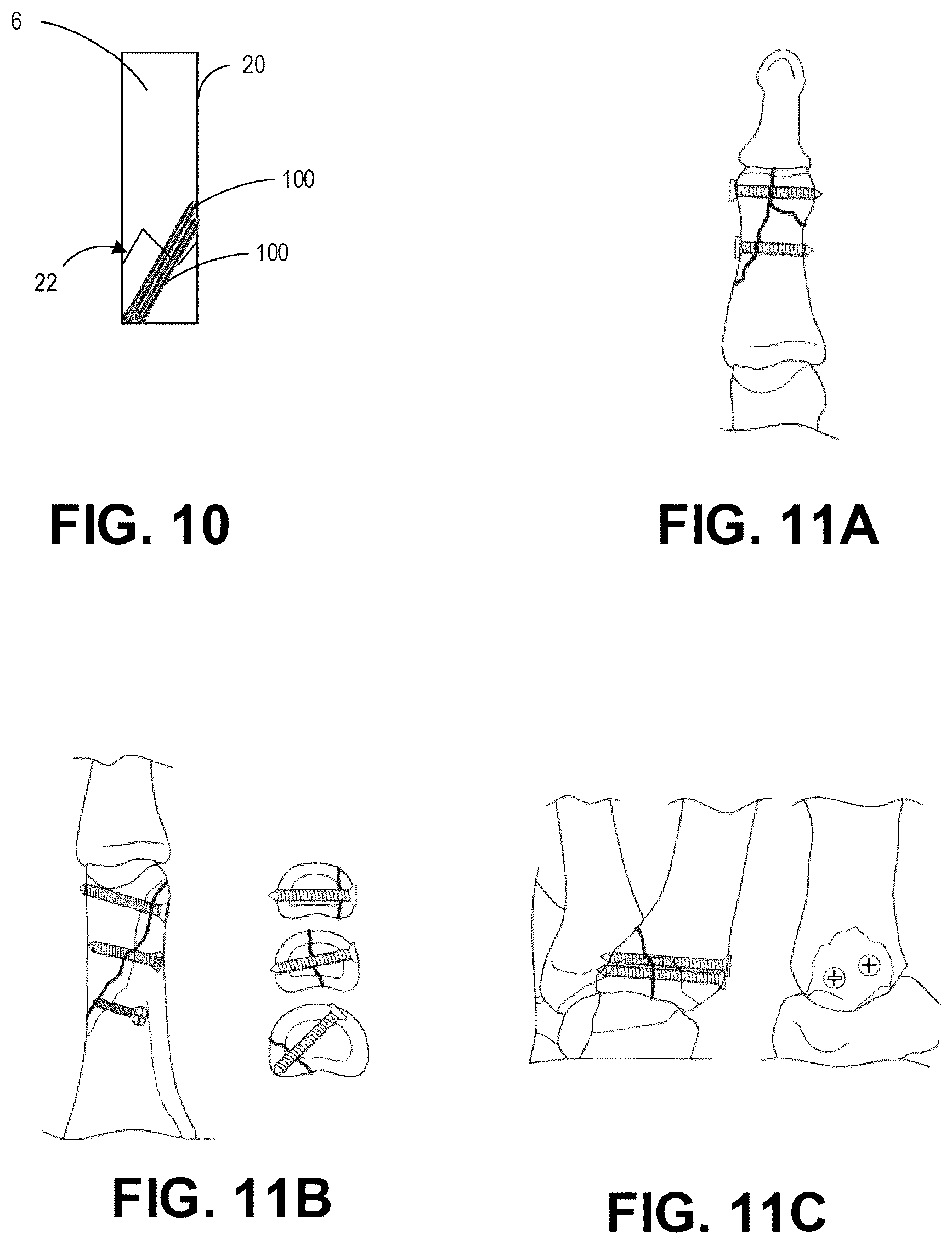 Patent US12137956 Figure 18 – Orthopedic implants and instruments for delivering the same