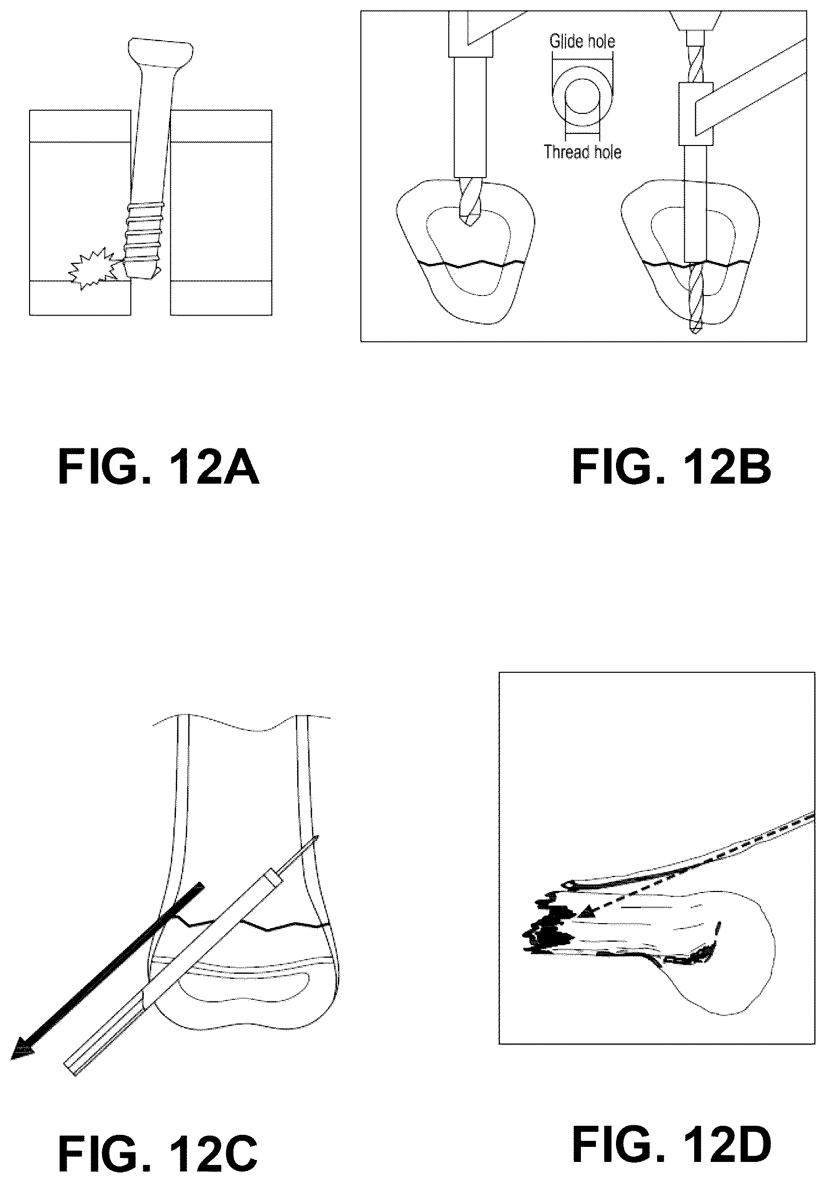 Patent US12137956 Figure 19 – Orthopedic implants and instruments for delivering the same