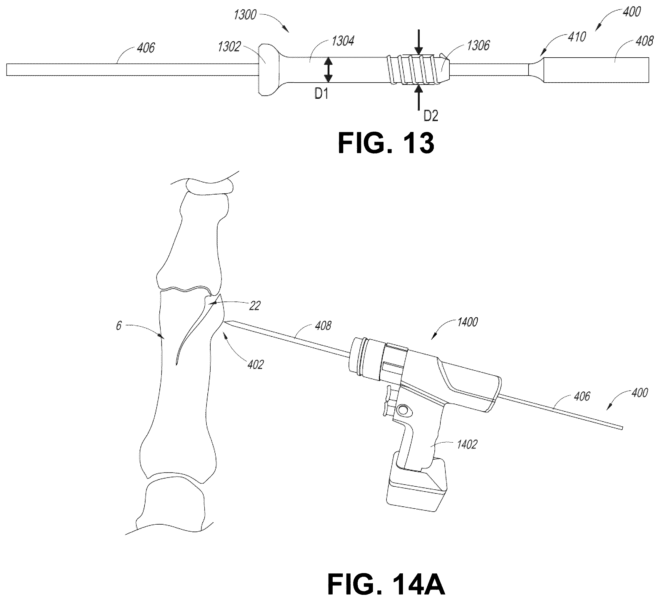 Patent US12137956 Figure 20 – Orthopedic implants and instruments for delivering the same
