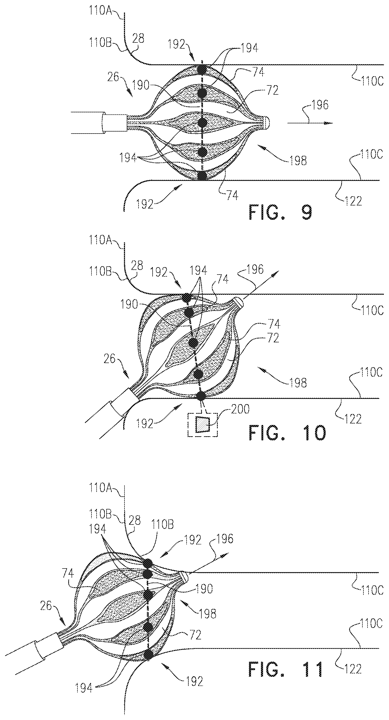 Patent US12137967 Figure 6 – Accurate positioning and shape visualization of balloon catheter ablation tags