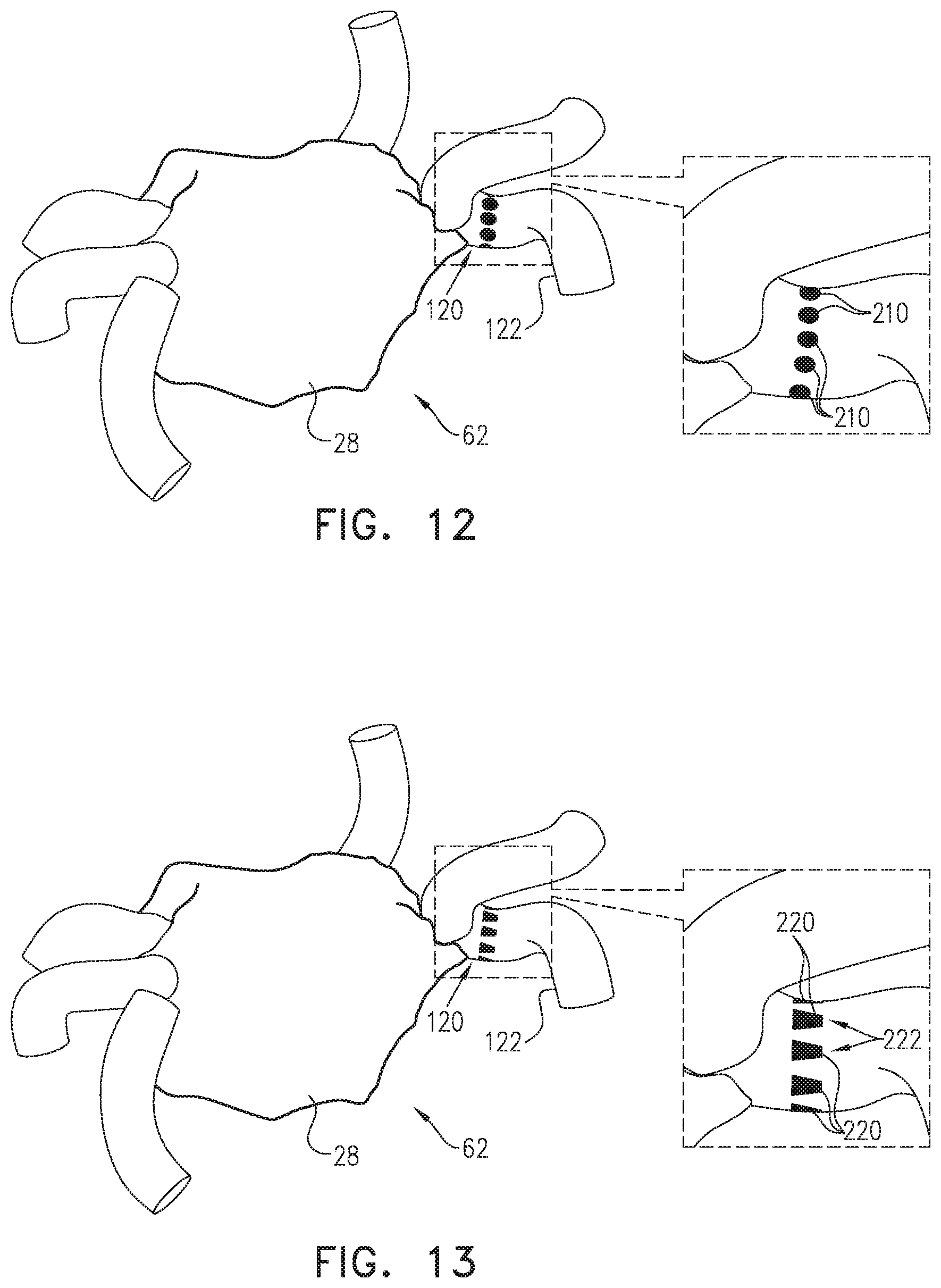 Patent US12137967 Figure 7 – Accurate positioning and shape visualization of balloon catheter ablation tags