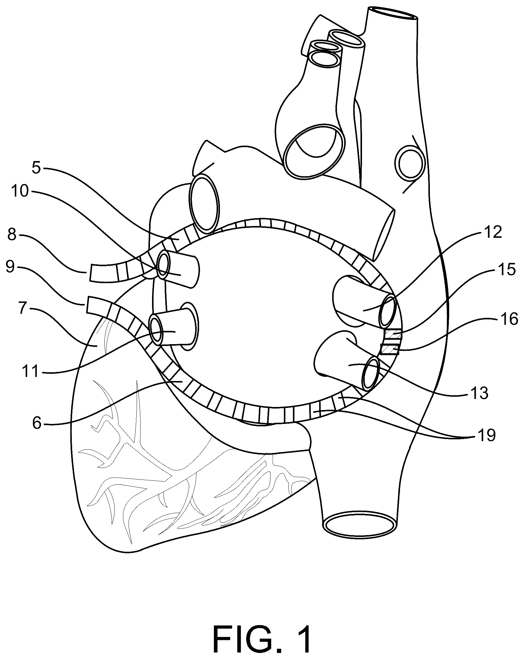 Patent US12137968 Figure 1 – Methods and apparatus for multi-catheter tissue ablation