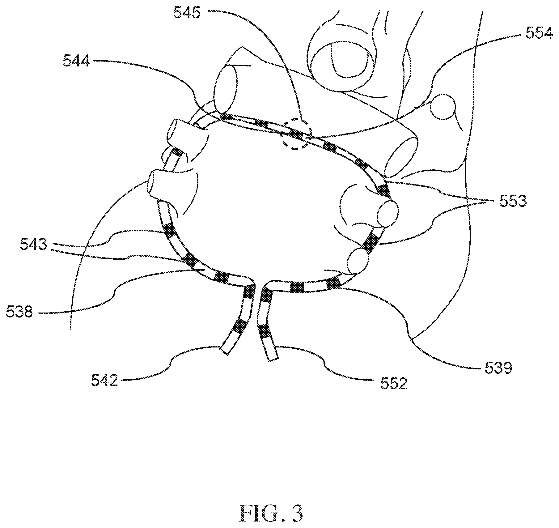 Patent US12137968 Figure 3 – Methods and apparatus for multi-catheter tissue ablation