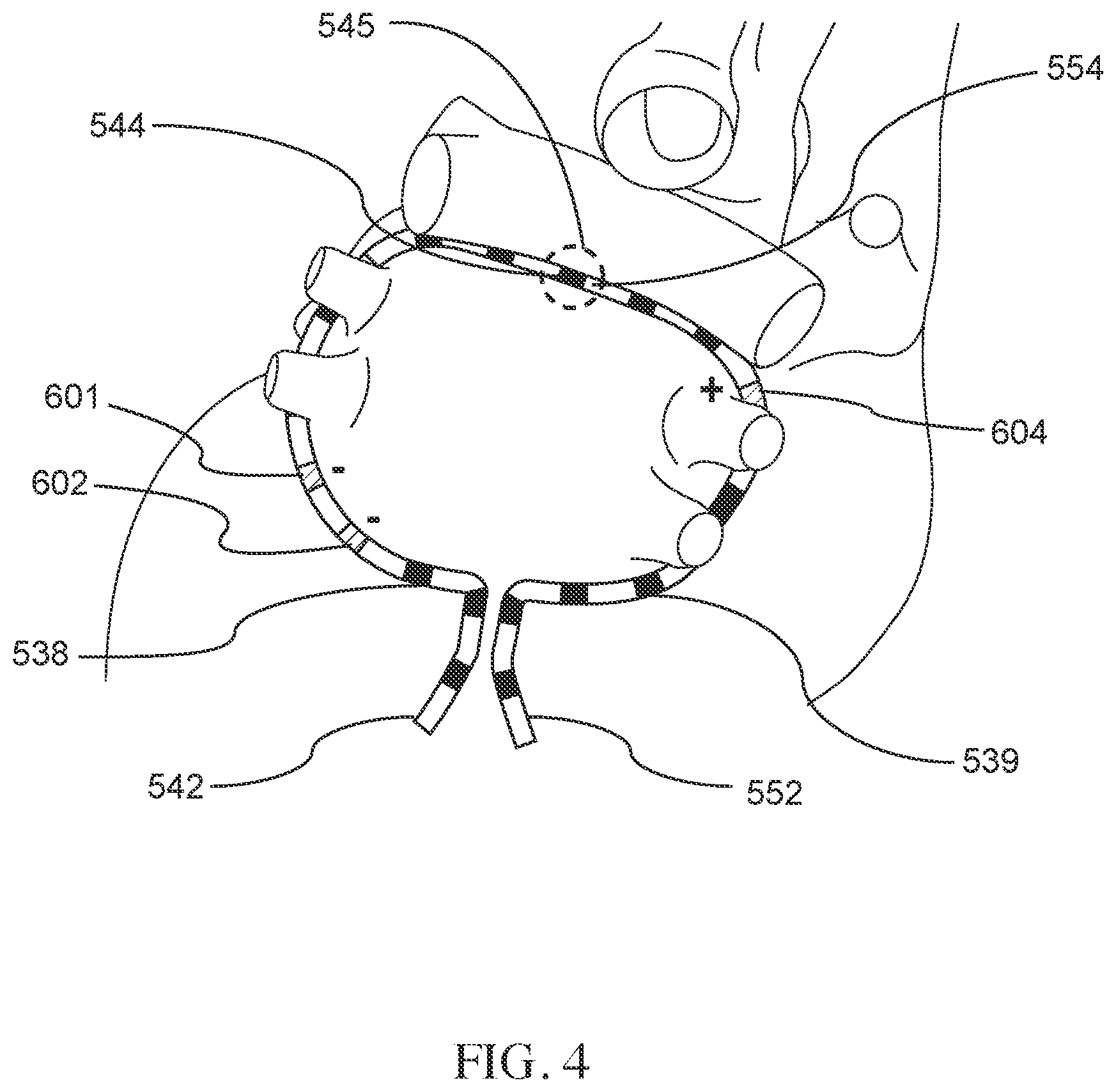 Patent US12137968 Figure 4 – Methods and apparatus for multi-catheter tissue ablation