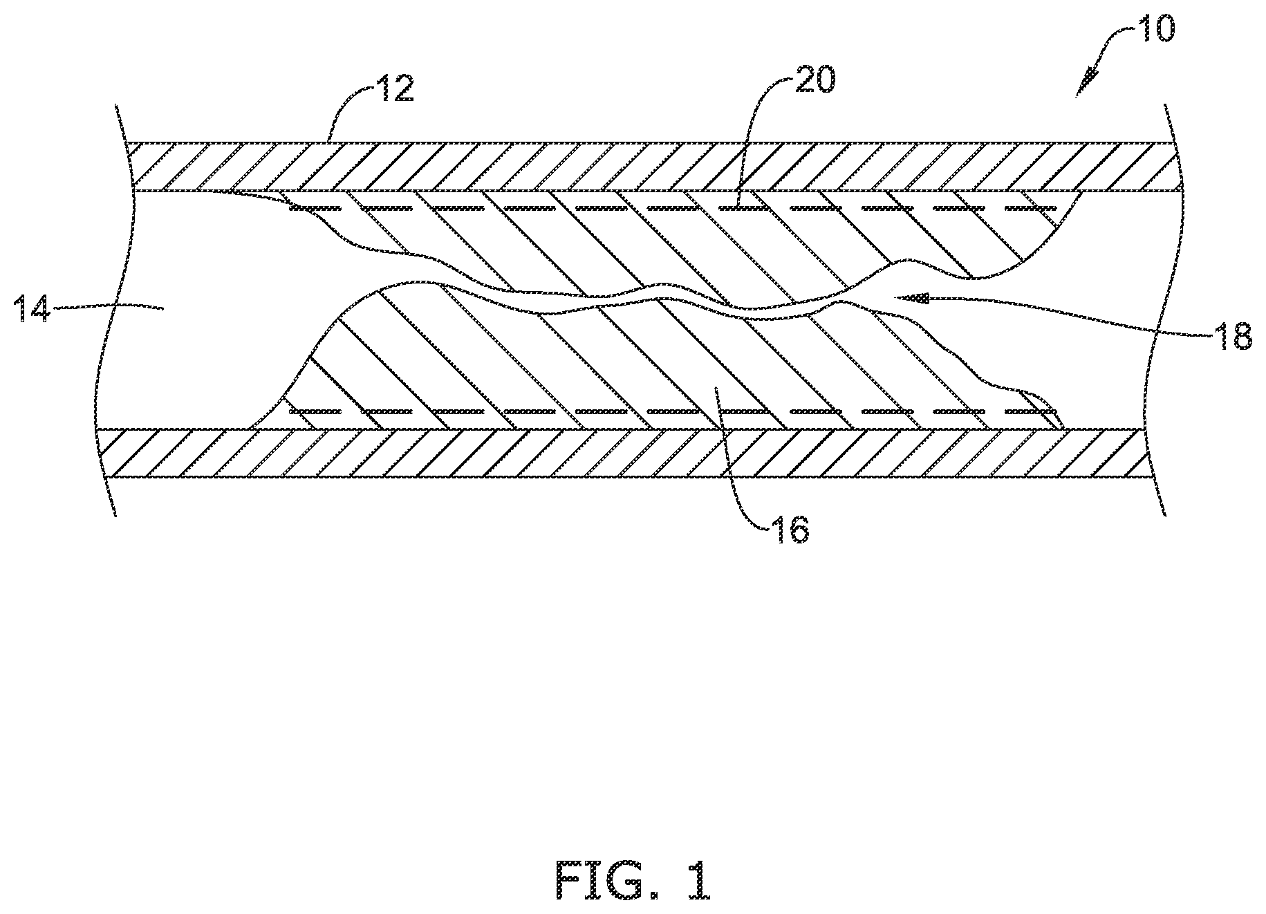 Patent US12137970 Figure 1 – Devices and methods for inducing ablation in or around occluded implants