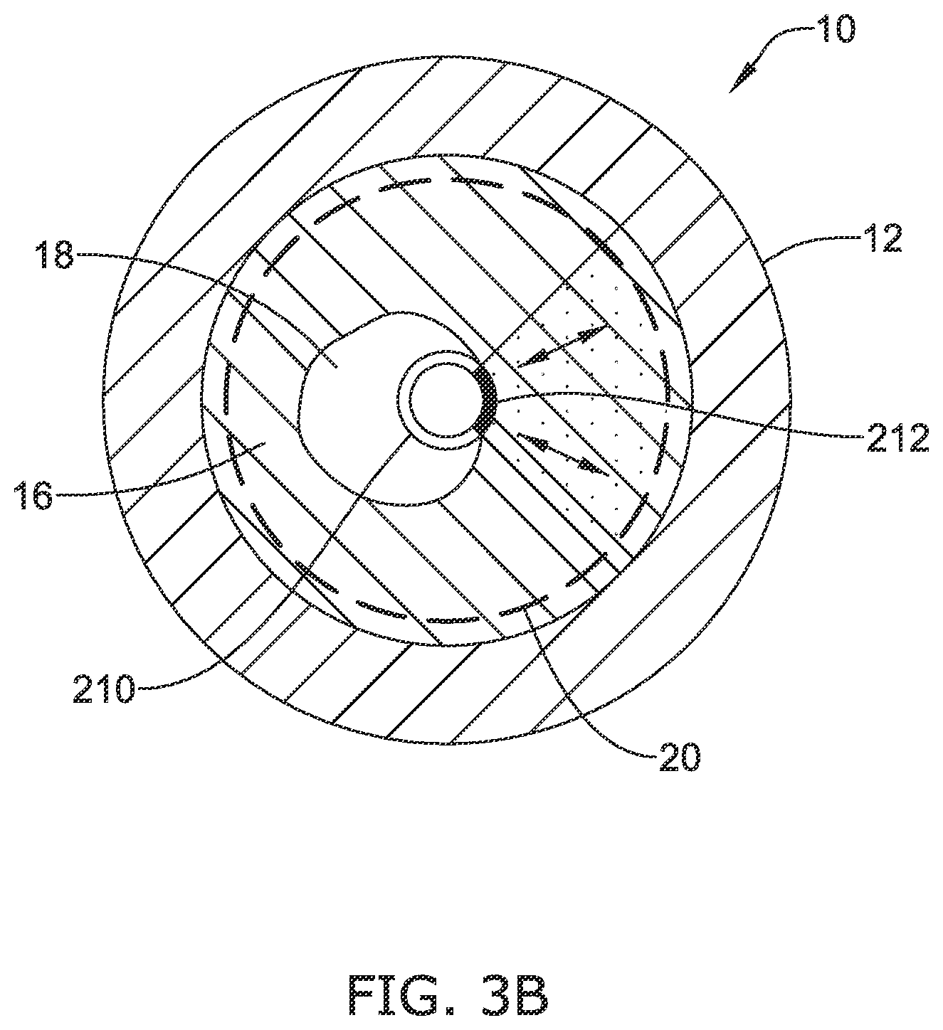 Patent US12137970 Figure 4 – Devices and methods for inducing ablation in or around occluded implants