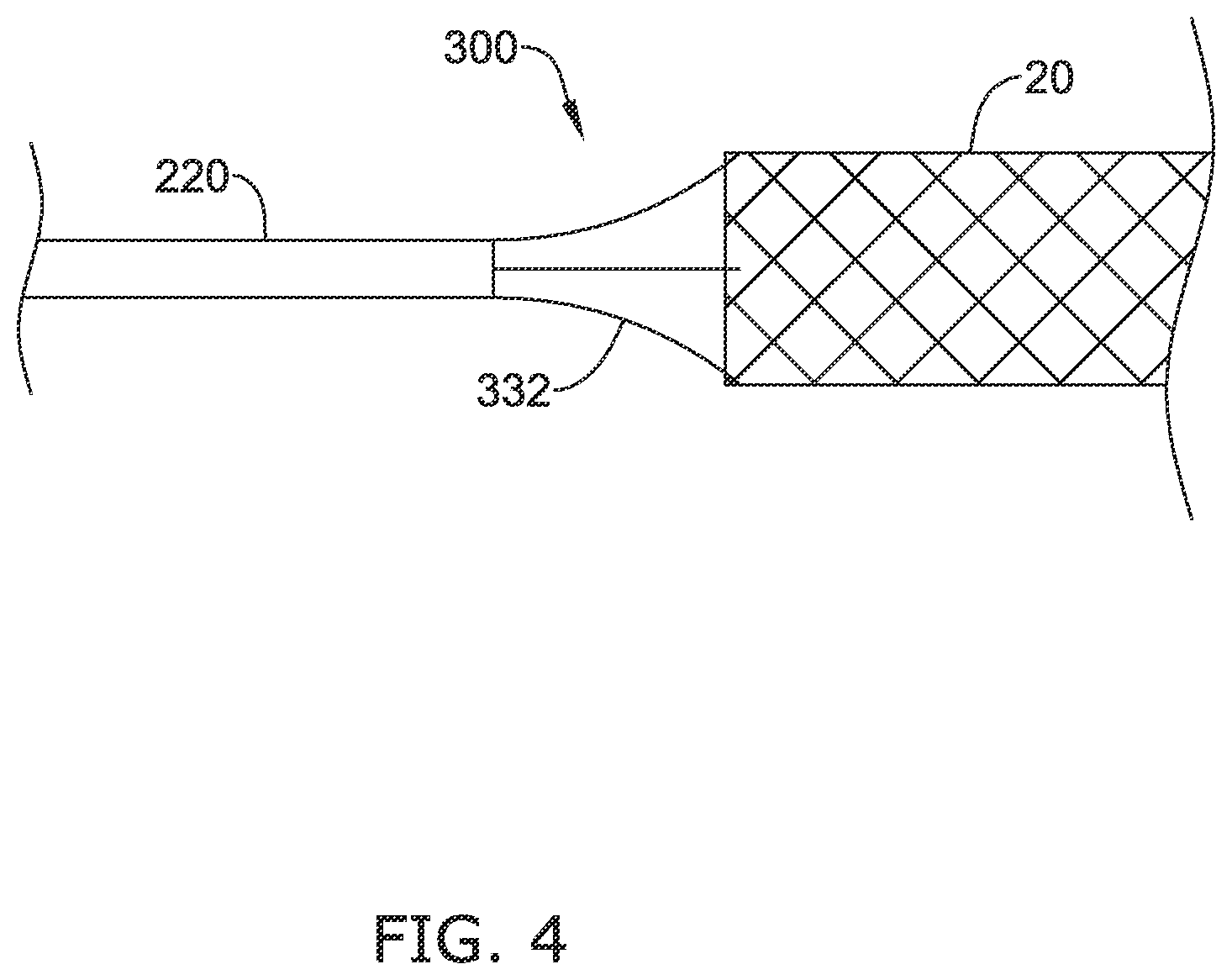 Patent US12137970 Figure 5 – Devices and methods for inducing ablation in or around occluded implants